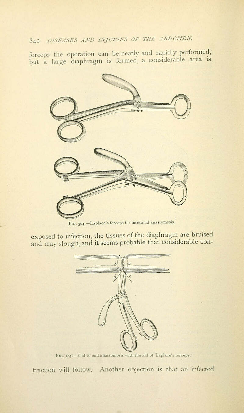 forceps the operation can be neatly and rapidly performed, but a large diaphragm is formed, a considerable area is Fig. 304.—Laplace's forceps for intestinal anastomosis. exposed to infection, the tissues of the diaphragm are bruised and may slough, and it seems probable that considerable con- Fig. 305.—End-to-end anastomosis with the aid of Laplace's forceps. traction will follow. Another objection is that an infected