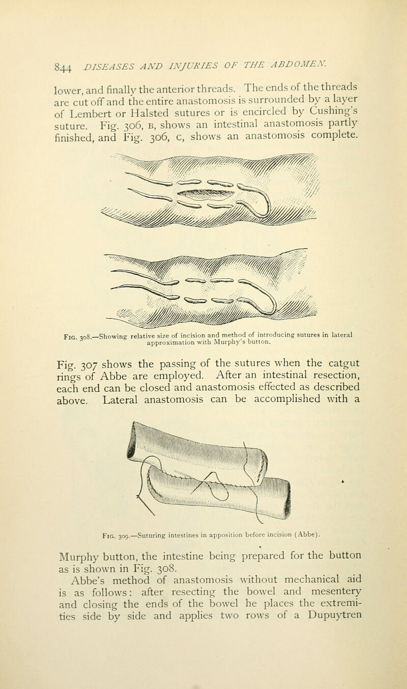 lower, and finally the anterior threads. The ends of the threads are cutoff and the entire anastomosis is surrounded by a layer of Lembert or Halsted sutures or is encircled by Cushing's suture. Fig. 306, B, shows an intestinal anastomosis partly finished, and Fig. 306, c, shows an anastomosis complete. Fig. 308.—! ■Showing relative size of incision and method of introducing sutures in lateral approximation with Murphy's button. Fio-. 307 shows the passing of the sutures when the catgut rings of Abbe are employed. After an intestinal resection, each end can be closed and anastomosis effected as described above. Lateral anastomosis can be accomplished with a ^^paTvrV^^ Fig. 309.—Suturing intestines in apposition before incision (Abbe). Murphy button, the intestine being prepared for the button as is shown in Fig. 308. Abbe's method of anastomosis without mechanical aid is as follows: after resecting the bowel and mesentery and closing the ends of the bowel he places the extremi- ties side by side and applies two rows of a Dupuytren