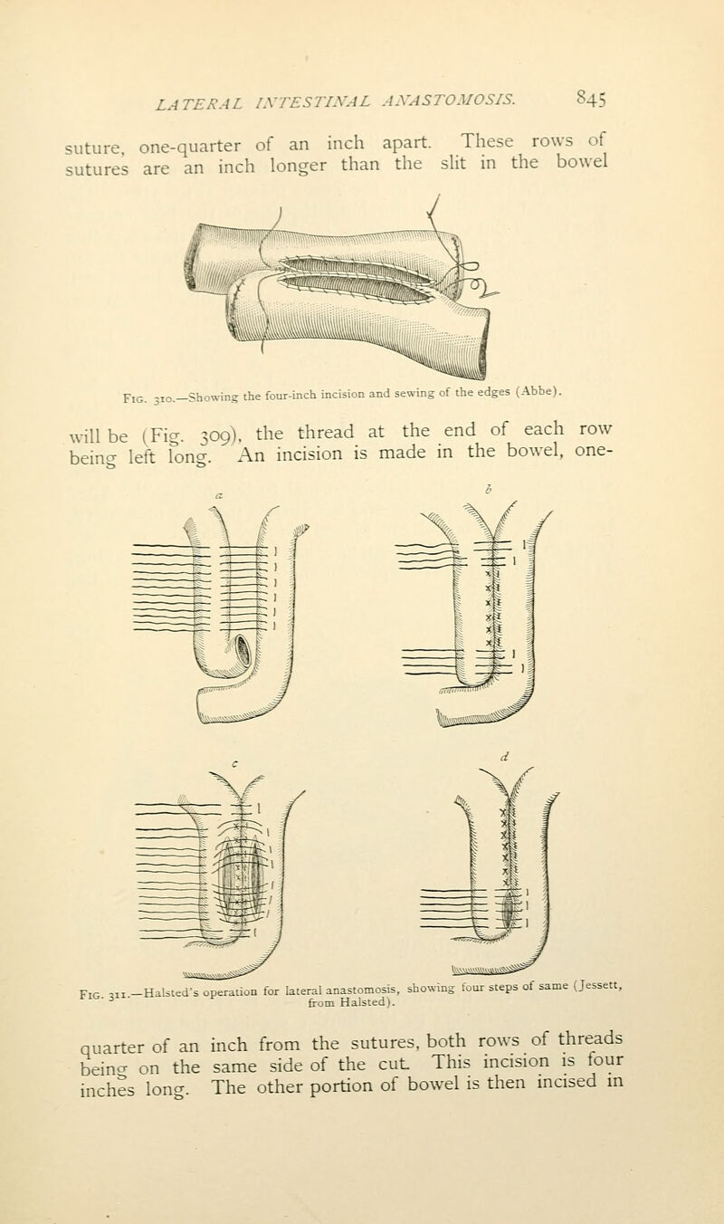 suture, one-quarter of an inch apart. These rows of sutures are an inch longer than the sHt in the bowel Fig. -10.—Showing- the four-inch incision and sewing of the edges (Abbe). will be (Fig. 309), the thread at the end of each row being left fong. An incision is made in the bowel, one- F:g ^ii —Halsted's operation for lateral anastomosis, showing four steps of same (Jessett,  ^ from Halsted). quarter of an inch from the sutures, both rows of threads beincT on the same side of the cut This incision is four inches long. The other portion of bowel is then incised in