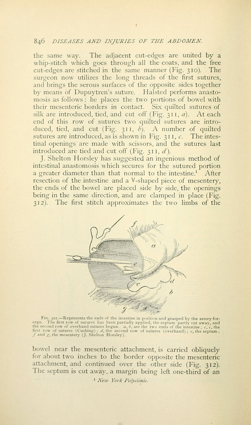 the same way. The adjacent cut-edges are united by a whip-stitch which goes through all the coats, and the free cut-edges are stitched in the same manner (Fig. 310). The surgeon now utilizes the long threads of the first sutures, and brings the serous surfaces of the opposite sides together by means of Dupuytren's suture. Halsted performs anasto- mosis as follows : he places the two portions of bowel with their mesenteric borders in contact. Six quilted sutures of silk are introduced, tied, and cut off (Fig. 311, a). At each end of this row of sutures two quilted sutures are intro- duced, tied, and cut (Fig. 311, Z-). A number of quilted sutures are introduced, as is shown in Fig. 311, c. The intes- tinal openings are made with scissors, and the sutures last introduced are tied and cut off (Fig. 311, d^. J. Shelton Horsley has suggested an ingenious method of intestinal anastomosis which secures for the sutured portion a greater diameter than that normal to the intestine.^ After resection of the intestine and a V-shaped piece of mesentery, the ends of the bowel are placed side by side, the openings being in the same direction, and are clamped in place (Fig. 312). The first stitch approximates the two limbs of the Fig. 312.—Represents the ends of the intestine in position and grasped by the artery-for- ceps. The first row of sutures has been partially applied, the septum partly cut away, and the second row of overhand sutures begun, a, b, are the two ends of the intestine ; c, c, the first row of sutures (Gushing); </, the second row of sutures (overhand); f, the septum ; y and g, the mesentery (J. Shelton Horsley). bowel near the mesenteric attachment, is carried obliquely for about two inches to the border opposite the mesenteric attachment, and continued over the other side (Fig. 312). The septum is cut away, a margin being left one-third of an ' A^eui York Polycii7iic.