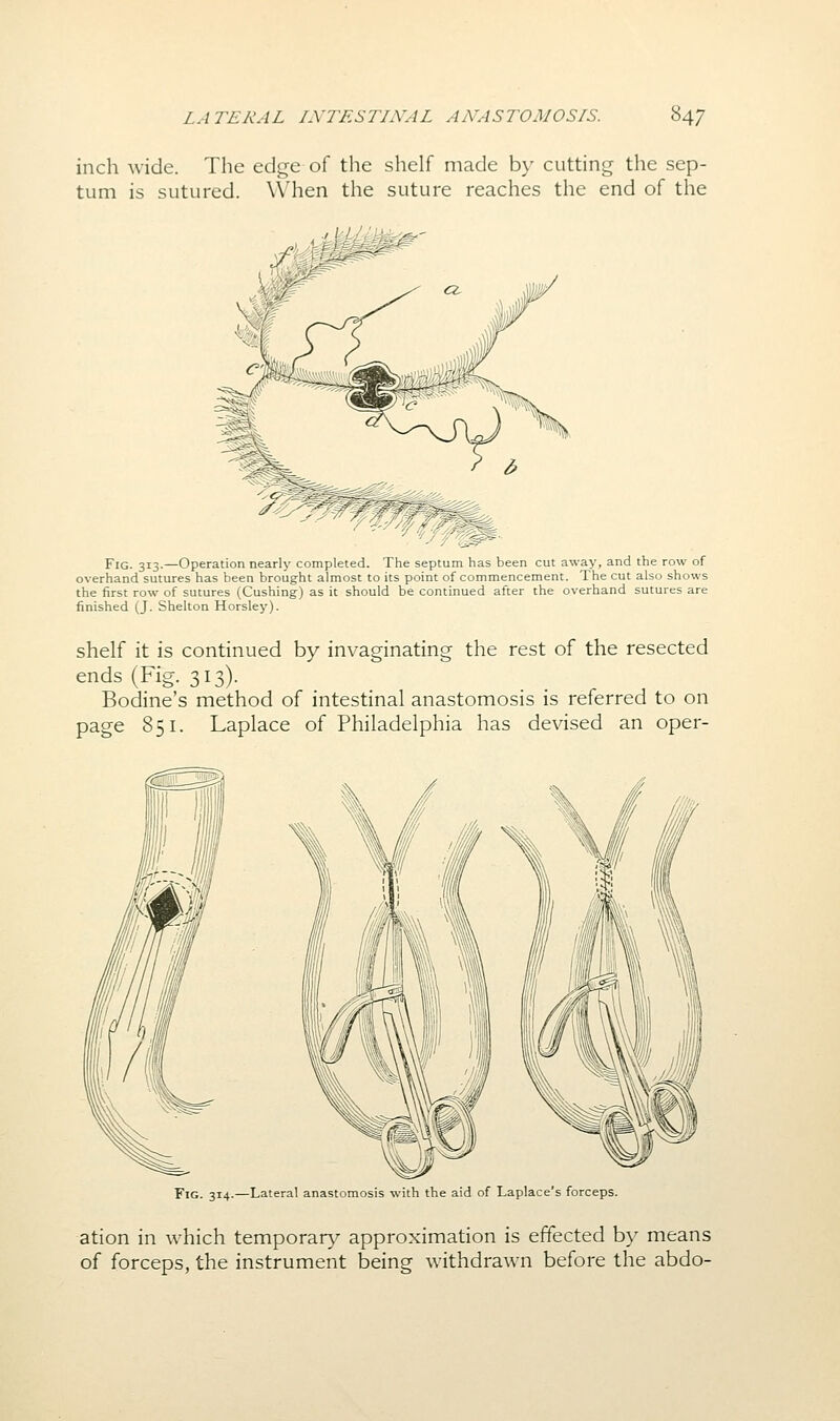 inch wide. The edge of the shelf made by cutting the sep- tum is sutured. When the suture reaches the end of the Fig. 313.—Operation nearly completed. The septum has been cut away, and the row of overhand sutures has been brought almost to its point of commencement. The cut also shows the first row of sutures (Gushing) as it should be continued after the overhand sutures are finished (J. Shelton Horsley). shelf it is continued by invaginating the rest of the resected ends (Fig. 313). Bodine's method of intestinal anastomosis is referred to on page 851. Laplace of Philadelphia has devised an oper- FiG. 314.—Lateral anastomosis with the aid of Laplace's forceps. ation in which temporar}^ approximation is effected by means of forceps, the instrument being withdrawn before the abdo-