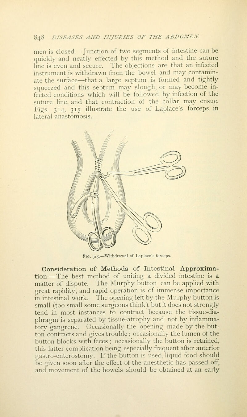 men is closed. Junction of two segments of intestine can be quickly and neatly effected by this method and the suture line is even and secure. The objections are that an infected instrument is withdrawn from the bowel and may contamin- ate the surface—that a large septum is formed and tightly squeezed and this septum may slough, or may become in- fected conditions which will be followed by infection of the suture line, and that contraction of the collar may ensue. Figs. 314, 315 illustrate the use of Laplace's forceps in lateral anastomosis. Fig. 315.—Withdrawal of Laplace's forceps. Consideration of Methods of Intestinal Approxima- tion.—The best method of uniting a divided intestine is a matter of dispute. The Murphy button can be applied with great rapidity, and rapid operation is of immense importance in intestinal work. The opening left by the Murphy button is small (too small some surgeons think), but it does not strongly tend in most instances to contract because the tissue-dia- phragm is separated by tissue-atrophy and not by inflamma- tory gangrene. Occasionally the opening made by the but- ton contracts and gives trouble ; occasionally the lumen of the button blocks with feces ; occasionally the button is retained, this latter complication being especially frequent after anterior gastro-enterostomy. If the button is used, liquid food should be given soon after the effect of the anesthetic has passed off, and movement of the bowels should be obtained at an early