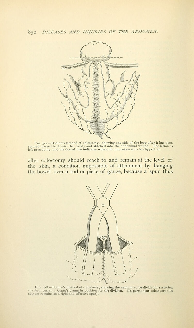 Fig. 317.—Bodine's method of colostomy, showing one side of the loop after it has been sutured, passed back into the cavity and stitched into the abdominal wound. The lesion is left protruding, and the dotted line indicates where the protrusion is to be clipped off. after colostomy should reach to and remain at the level of the skin, a condition impossible of attainment by hanging the bowel over a rod or piece of gauze, because a spur thus Fig. 318.—Bodine's method of colostomy, showing the septum to be divided in restoring the fecal current; Grant's clamp in position for the division. (In permanent colostomy this septum remains as a rigid and effective spur).