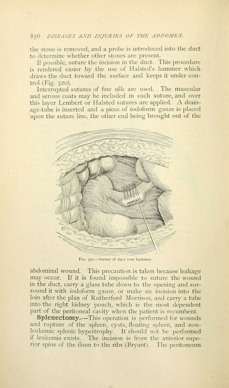 the stone is removed, and a probe is introduced into the duct to determine whether other stones are present. If possible, suture the incision in the duct. This procedure is rendered easier by the use of Halsted's hammer which draws the duct toward the surface and keeps it under con- trol (Fig. 320). Interrupted sutures of fine silk are used. The muscular and serous coats may be included in each suture, and over this layer Lembert or Halsted sutures are applied. A drain- age-tube is inserted and a piece of iodoform gauze is placed upon the suture line, the other end being brought out of the Fig. 320.—Suture of duct over hammer. abdominal wound. This precaution is taken because leakage may occur. If it is found impossible to suture the wound in the duct, carry a glass tube down to the opening and sur- round it with iodoform gauze, or make an incision into the loin after the plan of Rutherford Morrison, and carry a tube into the right kidney pouch, which is the most dependent part of the peritoneal cavity when the patient is recumbent. Splenectomy.—This operation is performed for wounds and rupture of the spleen, cysts, floating spleen, and non- leukemic splenic hypertrophy. It should not be performed if leukemia exists. The incision is from the anterior supe- rior spine of the ilium to the ribs (Bryant). The peritoneum