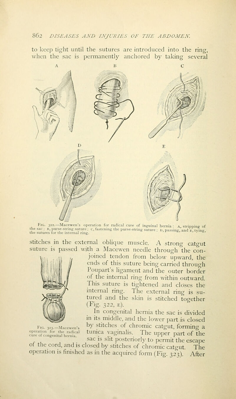 to keep tight until the sutures are introduced into the ring, when the sac is permanently anchored by taking several ^::a\ Fig. 322.—Macewen's operation for radical cure of ing-umal hernia ■ a stripping of the sac ; b, purse-string suture ; c, fastening the purse-string suture , d, passing 'and e tying the sutures for the internal ring. » .» &> stitches in the external oblique muscle. A strono- catgut suture is passed with a Macewen needle through the con- joined tendon from below upward, the ends of this suture being carried through Poupart's ligament and the outer border of the internal ring from within outward. This suture is tightened and closes the internal ring. The external ring is su- tured and the skin is stitched together (Fig. 322, e). In congenital hernia the sac is divided in its middle, and the lower part is closed by stitches of chromic catgut, forming a tunica vaginalis. The upper part of the sac is slit posteriorly to permit the escape of the cord, and is closed by stitches of chromic catgut. The operation is finished as in the acquired form (Fig. 323). After Fig. 323.—Macewen's operation for the radical
