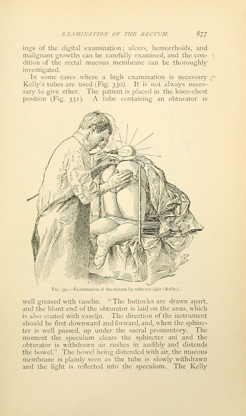 ings of the digital examination ; ulcers, hemorrhoids, and malignant growths can be carefulK' examined, and the con- dition of the rectal mucous membrane can be thoroughly investigated. In some cases where a high examination is necessaiy j* Kelly's tubes are used (Fig. 330). It is not always neces- sar)- to give ether. The patient is placed in the knee-chest position (Fig. 331). A tube containing an obturator is Fig. 331.—Examination of the rectum by reflected light ^Kelly). well greased with vaselin.  The buttocks are drawn apart, and the blunt end of the obturator is laid on the anus, which is also coated with vaselm. The direction of the instrument should be first downward and forward, and, when the sphinc- ter is well passed, up under the sacral promontory. The moment the speculum clears the sphincter ani and the obturator is withdrawn air rushes in audibh' and distends the bowel. The bowel being distended with air. the mucous mem.brane is plainly seen as the tube is sloAvly withdrawn and the light is reflected into the speculum. The Kelly