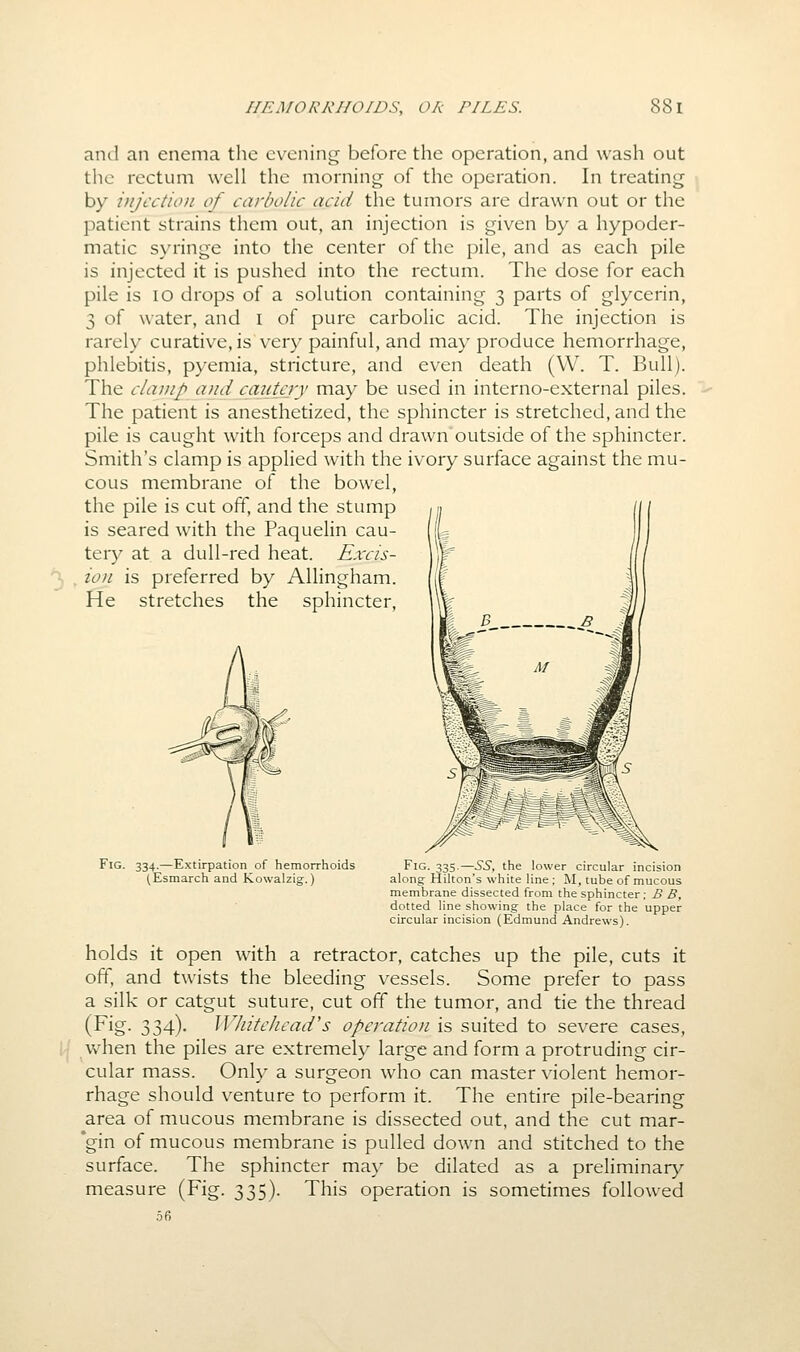 ami an enema the evening before the operation, and wash out the rectum well the morning of the operation. In treating by injection of carbolic acid the tumors are drawn out or the patient strains them out, an injection is given by a hypoder- matic syringe into the center of the pile, and as each pile is injected it is pushed into the rectum. The dose for each pile is lo drops of a solution containing 3 parts of glycerin, 3 of water, and i of pure carbolic acid. The injection is rarely curative, is very painful, and may produce hemorrhage, phlebitis, pyemia, stricture, and even death (W. T. Bull). The clamp and cautery may be used in interno-external piles. The patient is anesthetized, the sphincter is stretched, and the pile is caught with forceps and drawn outside of the sphincter. Smith's clamp is applied with the ivory surface against the mu- cous membrane of the bowel, the pile is cut off, and the stump is seared with the Paquelin cau- tery at a dull-red heat. Excis- '^ , ion is preferred by Allingham. He stretches the sphincter, Fig. 334.—Extirpationof hemorrhoids Fig. 335.—55, the lower circular incision (Esmarch and Kowalzig.) along: Hilton's white line; M, tube of mucous membrane dissected from the sphincter ; B B, dotted line showing- the place for the upper circular incision (Edmund Andrews). holds it open with a retractor, catches up the pile, cuts it off, and twists the bleeding vessels. Some prefer to pass a silk or catgut suture, cut off the tumor, and tie the thread (Fig. 334). Whitehead's operation is suited to severe cases, when the piles are extremely large and form a protruding cir- cular mass. Only a surgeon who can master violent hemor- rhage should venture to perform it. The entire pile-bearing area of mucous membrane is dissected out, and the cut mar- *gin of mucous membrane is pulled down and stitched to the surface. The sphincter may be dilated as a preliminar}'- measure (Fig. 335). This operation is sometimes followed 5fi