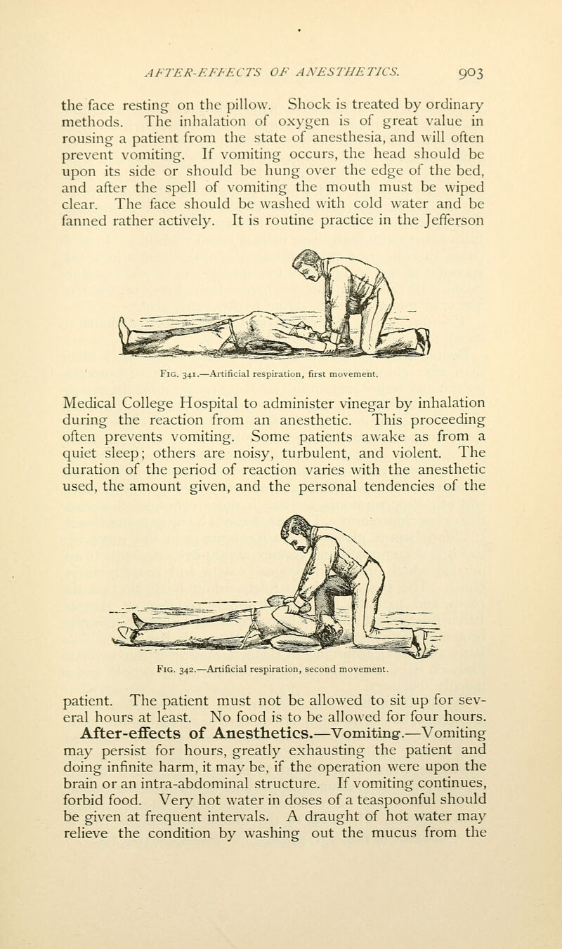 the face resting on the pillow. Shock is treated by ordinary methods. The inhalation of oxygen is of great value in rousing a patient from the state of anesthesia, and will often prevent vomiting. If vomiting occurs, the head should be upon its side or should be hung over the edge of the bed, and after the spell of vomiting the mouth must be wiped clear. The face should be washed with cold water and be fanned rather actively. It is routine practice in the Jefferson Fig. 341.—Artificial respiration, first movement. Medical College Hospital to administer vinegar by inhalation during the reaction from an anesthetic. This proceeding often prevents vomiting. Some patients awake as from a quiet sleep; others are noisy, turbulent, and violent. The duration of the period of reaction varies with the anesthetic used, the amount given, and the personal tendencies of the Fig. 342.—Artificial respiration, second movement. patient. The patient must not be allowed to sit up for sev- eral hours at least. No food is to be allowed for four hours. After-effects of Anesthetics.—Vomiting-.—Vomiting may persist for hours, greatly exhausting the patient and doing infinite harm, it maybe, if the operation were upon the brain or an intra-abdominal structure. If vomiting continues, forbid food. Very hot water in doses of a teaspoonful should be given at frequent intei-vals. A draught of hot water may relieve the condition by washing out the mucus from the