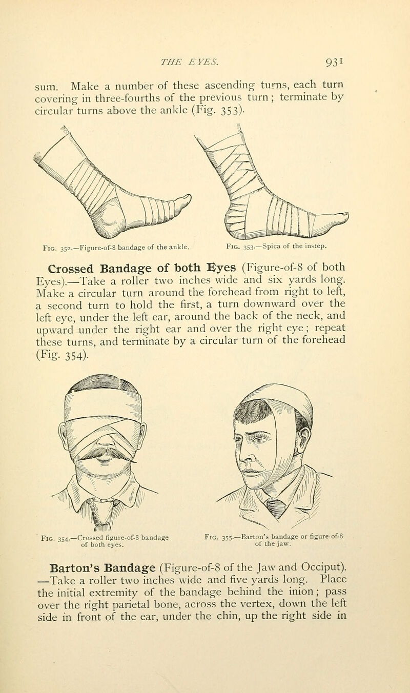 sum. Make a number of these ascending turns, each turn covering in three-fourths of the previous turn ; terminate by circular turns above the ankle (Fig. 353). Fig. 352.—Figure-of-8 bandage of the ankle. Fig. 353.—Spica of the instep. Crossed Bandage of both Byes (Figure-of-8 of both Eyes).—Take a roller two inches wide and six yards long. Make a circular turn around the forehead from right to left, a second turn to hold the first, a turn downward over the left eye, under the left ear, around the back of the neck, and upward under the right ear and over the right eye ; repeat these turns, and terminate by a circular turn of the forehead (Fig. 354). Fig. 354.—Crossed figure-of-8 bandage of both eyes. Fig. 355.—Barton's bandage or figure-of-8 of the jaw. Barton's Bandage (Figure-of-8 of the Jaw and Occiput). —Take a roller two inches wide and five yards long. Place the initial extremity of the bandage behind the inion ; pass over the right parietal bone, across the vertex, down the left side in front of the ear, under the chin, up the right side in