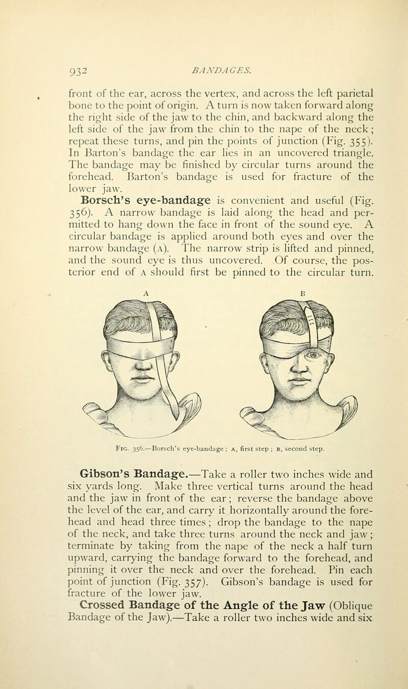 front of the ear, across the vertex, and across the left parietal bone to the point of origin. A turn is now taken forward along the right side of the jaw to the chin, and backward along the left side of the jaw from the chin to the nape of the neck; repeat these turns, and pin the points of junction (Fig. 355). In Barton's bandage the ear lies in an uncovered triangle. The bandage may be finished by circular turns around the forehead. Barton's bandage is used for fracture of the lower jaw. Borsch's eye-bandage is convenient and useful (Fig. 356). A narrow bandage is laid along the head and per- mitted to hang down the face in front of the sound eye. A circular bandage is applied around both eyes and over the narrow bandage (a). The narrow strip is lifted and pinned, and the sound eye is thus uncovered. Of course, the pos- terior end of A should first be pinned to the circular turn. Fig. 356.—Borsch's eye-bandage : A, first step ; B, second step. Gibson's Bandage.—Take a roller two inches wide and six yards long. Make three vertical turns around the head and the jaw in front of the ear; reverse the bandage above the level of the ear, and carry it horizontally around the fore- head and head three times; drop the bandage to the nape of the neck, and take three turns around the neck and jaw; terminate by taking from the nape of the neck a half turn upward, carrying the bandage forward to the forehead, and pinning it over the neck and over the forehead. Pin each point of junction (Fig. 357). Gibson's bandage is used for fracture of the lower jaw. Crossed Bandage of the Angle of the Jaw (Oblique Bandage of the Jaw).—Take a roller two inches wide and six