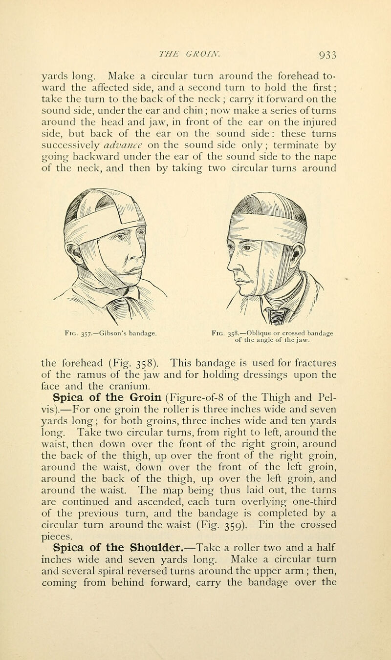 THE GROIN. 93; yards long. Make a circular turn around the forehead to- ward the affected side, and a second turn to hold the first; take the turn to the back of the neck ; carry it forward on the sound side, under the ear and chin; now make a series of turns around the head and jaw, in front of the ear on the injured side, but back of the ear on the sound side: these turns successively advance on the sound side only; terminate by going backward under the ear of the sound side to the nape of the neck, and then by taking two circular turns around Fig. 357.—Gibson's bandage. Fig. 358.—Oblique or crossed bandage of the angle of the jaw. the forehead (Fig. 358). This bandage is used for fractures of the ramus of the jaw and for holding dressings upon the face and the cranium. Spica of the Groin (Figure-of-8 of the Thigh and Pel- vis).—For one groin the roller is three inches wide and seven yards long; for both groins, three inches wide and ten yards long. Take two circular turns, from right to left, around the waist, then down over the front of the right groin, around the back of the thigh, up over the front of the right groin, around the waist, down over the front of the left groin, around the back of the thigh, up over the left groin, and around the waist. The map being thus laid out, the turns are continued and ascended, each turn overlying one-third of the previous turn, and the bandage is completed by a circular turn around the waist (Fig. 359). Pin the crossed pieces. Spica of the Shoulder.—Take a roller two and a half inches wide and seven yards long. Make a circular turn and several spiral reversed turns around the upper arm ; then, coming from behind forward, carry the bandage over the