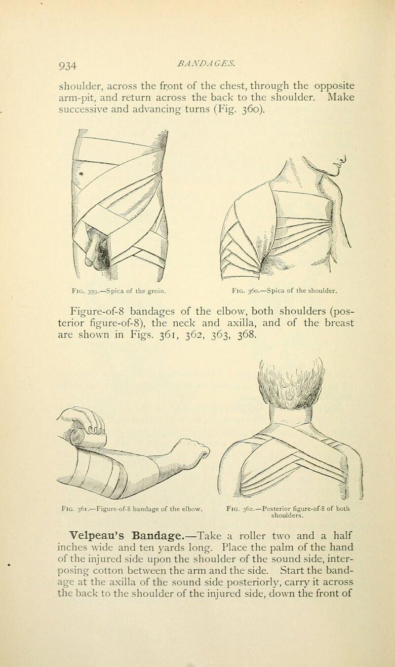 BAND A GES. shoulder, across the front of the chest, through the opposite arm-pit, and return across the back to the shoulder. Make successive and advancing turns (Fig. 360). Fig. 359.—Spica of the groin. Fig. 360.—Spica of the shoulder. Figure-of-8 bandages of the elbow, both shoulders (pos- terior figure-of-8), the neck and axilla, and of the breast are shown in Figs. 361, 362, 363, 368. Fig. 361.—Figure-of-8 bandage of the elbow. Fig. 362.—Posterior figure-of-8 of both shoulders. Velpeau'S Bandage.—Take a roller two and a half inches wide and ten yards long. Place the palm of the hand of the injured side upon the shoulder of the sound side, inter- posing cotton between the arm and the side. Start the band- age at the axilla of the sound side posteriorly, carry it across the back to the shoulder of the injured side, down the front of
