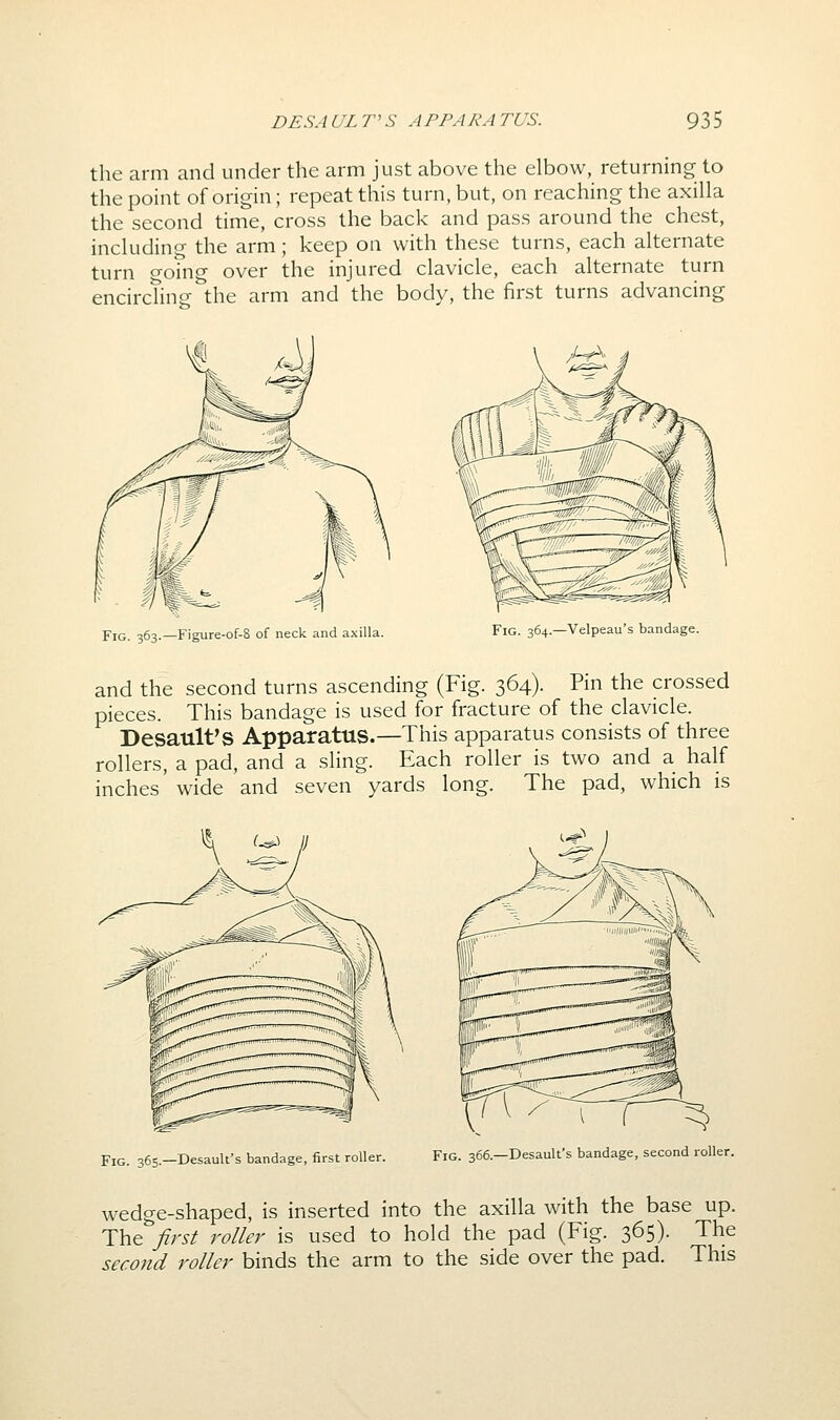 the arm and under the arm just above the elbow, returning to the point of origin; repeat this turn, but, on reaching the axilla the second time, cross the back and pass around the chest, including the arm; keep on with these turns, each alternate turn o-oing over the injured clavicle, each alternate turn encircTing the arm and the body, the first turns advancing .-UA> Fig. 363.—Figure-of-8 of neck and axilla. Fig. 364.—Velpeau's bandage. and the second turns ascending (Fig. 364). Pin the crossed pieces. This bandage is used for fracture of the clavicle. Desault'S Apparatus.—This apparatus consists of three rollers, a pad, and a sling. Each roller is two and a half inches wide and seven yards long. The pad, which is Fig. 365.-Desault's bandage, first roller. Fig. 366.-Desaulfs bandage, second roller. wedge-shaped, is inserted into the axilla with the base up. The first roller is used to hold the pad (Fig. 365). The second roller binds the arm to the side over the pad. This