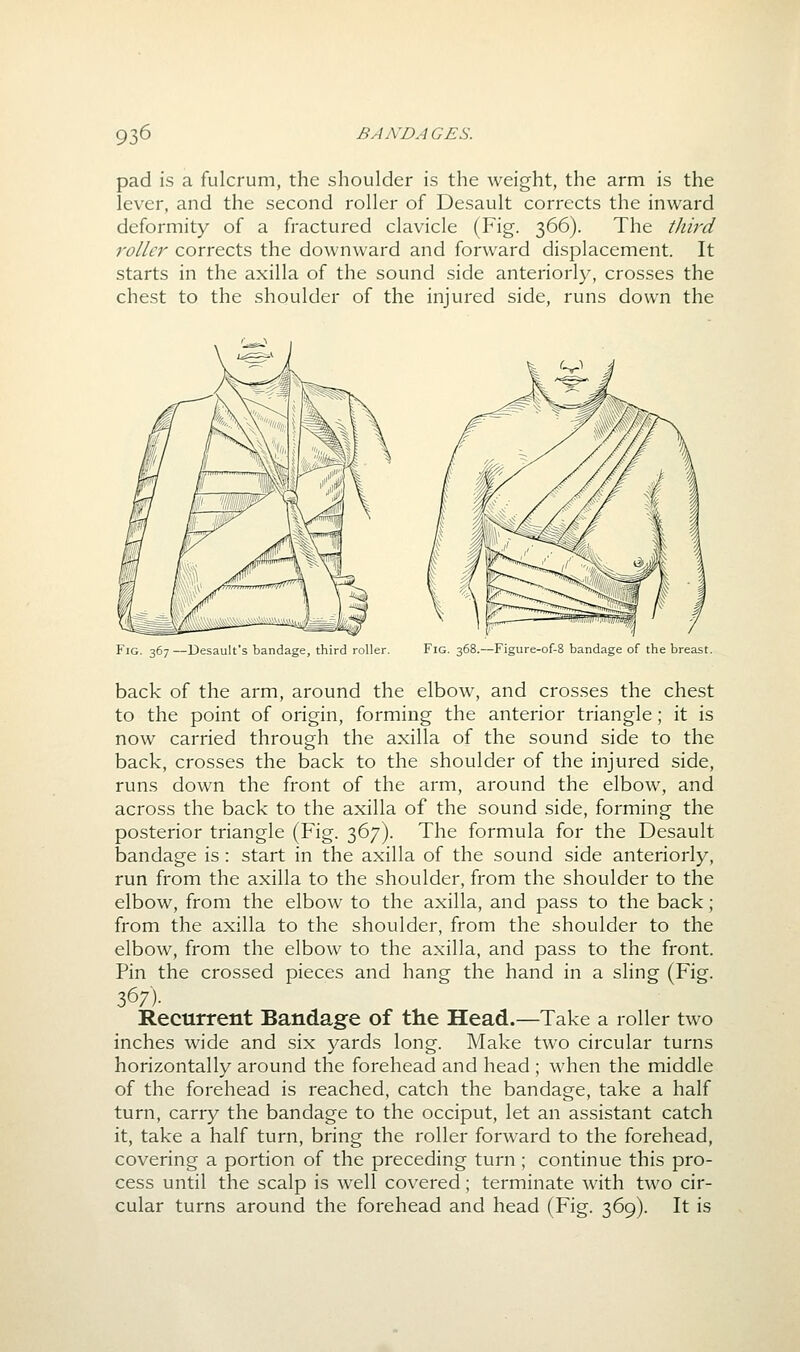 pad is a fulcrum, the shoulder is the weight, the arm is the lever, and the second roller of Desault corrects the inward deformity of a fractured clavicle (Fig. 366). The third roller corrects the downward and forward displacement. It starts in the axilla of the sound side anteriorly, crosses the chest to the shoulder of the injured side, runs down the Fig. -Desault's bandage, third roller Fig. 368.—Figure-of-8 bandage of the breast. back of the arm, around the elbow, and crosses the chest to the point of origin, forming the anterior triangle; it is now carried through the axilla of the sound side to the back, crosses the back to the shoulder of the injured side, runs down the front of the arm, around the elbow, and across the back to the axilla of the sound side, forming the posterior triangle (Fig. 367). The formula for the Desault bandage is : start in the axilla of the sound side anteriorly, run from the axilla to the shoulder, from the shoulder to the elbow, from the elbow to the axilla, and pass to the back; from the axilla to the shoulder, from the shoulder to the elbow, from the elbow to the axilla, and pass to the front. Pin the crossed pieces and hang the hand in a sling (Fig. 367)- Recurrent Bandage of the Head.—Take a roller two inches wide and six yards long. Make two circular turns horizontally around the forehead and head ; when the middle of the forehead is reached, catch the bandage, take a half turn, carry the bandage to the occiput, let an assistant catch it, take a half turn, bring the roller forward to the forehead, covering a portion of the preceding turn ; continue this pro- cess until the scalp is well covered; terminate with two cir- cular turns around the forehead and head (Fig. 369). It is