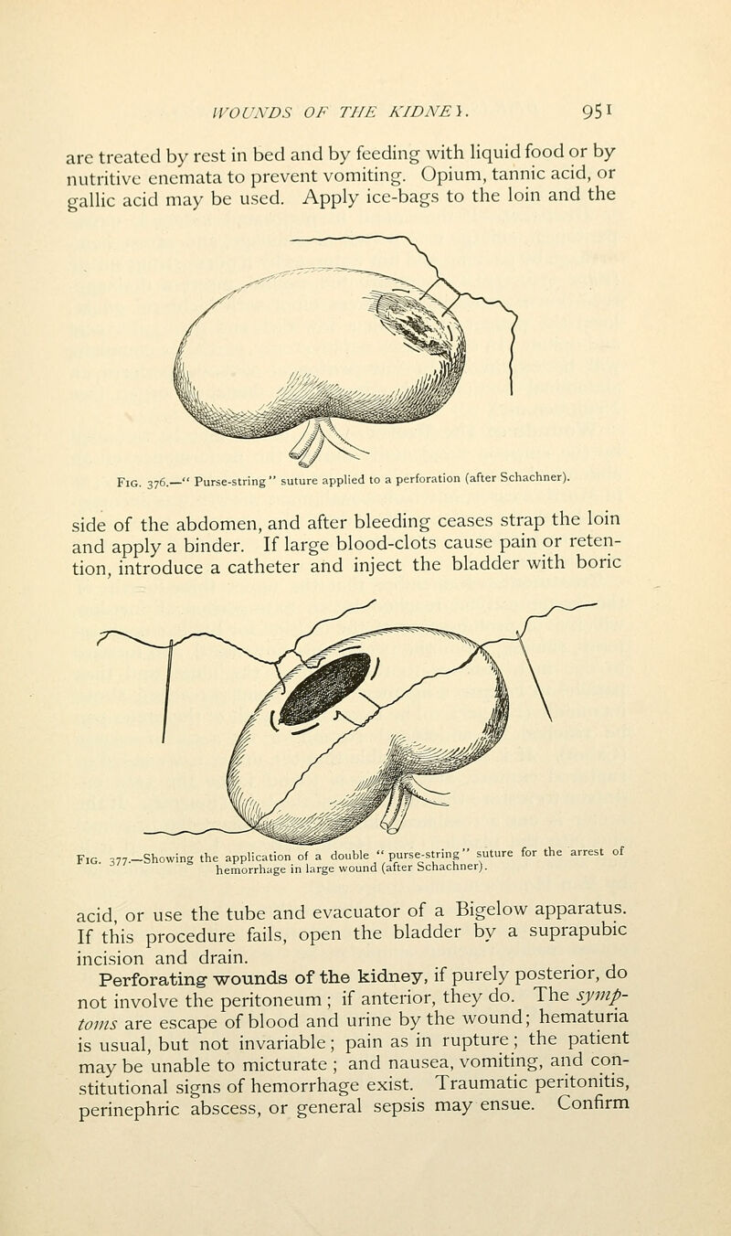 are treated by rest in bed and by feeding with liquid food or by nutritive enemata to prevent vomiting. Opium, tannic acid, or gallic acid may be used. Apply ice-bags to the loin and the Fig. 376.— Purse-string suture applied to a perforation (after Schachner). side of the abdomen, and after bleeding ceases strap the loin and apply a binder. If large blood-clots cause pain or reten- tion, introduce a catheter and inject the bladder with boric Fig. 377—Showing the application of a double purse-string suture for the arrest of hemorrhage in large wound (after Schachner). acid, or use the tube and evacuator of a Bigelow apparatus. If this procedure fails, open the bladder by a suprapubic incision and drain. Perforating wounds of the kidney, if purely posterior, do not involve the peritoneum ; if anterior, they do. The symp- toms are escape of blood and urine by the wound; hematuria is usual, but not invariable; pain as in rupture; the patient may be unable to micturate ; and nausea, vomiting, and con- stitutional signs of hemorrhage exist. Traumatic peritonitis, perinephric abscess, or general sepsis may ensue. Confirm