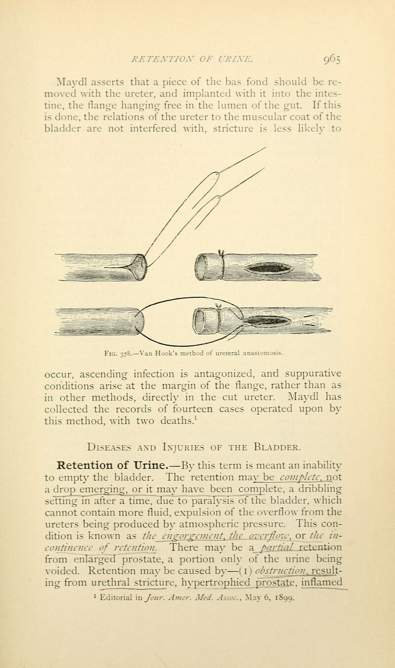 ]\Ia}dl asserts that a piece of the bas fond should be re- moved with the ureter, and implanted with it into the intes- tine, the flange hanging free in the lumen of the gut. If this is done, the relations of the ureter to the muscular coat of the bladder are not interfered with, stricture is less likeh- to Fig. 37S.—Van Hook's method of ureteral anastomosis. occur, ascending infection is antagonized, and suppurative conditions arise at the margin of the flange, rather than as in other methods, directly in the cut ureter. ]Maydl has collected the records of fourteen cases operated upon b}- this method, with two deaths.^ Diseases and In'juries of the Bladder. Retention of Urine.—By this term is meant an inabilit}- to empt}- the bladder. The retention mav be complete, v^ot a drop emerging, or it may have been complete, a dribbling seTting in after a time, due to paralysis of the bladder, which cannot contain more fluid, expulsion of the overflow from the ureters being produced by atmospheric pressure. This con- dition is known as thc_cngorgciiic]it. the ovcrjloic, or the iii- coiitiTicnce of reteiition. There ma\' be a_/rt^;::^/<iZ_xeteution from enFarge^ prostate, a portion only of the urine being voided. Retention may be caused by—(i) obstriiction. result- ing from urethral stricture, hypertrophied prostate, inflamed