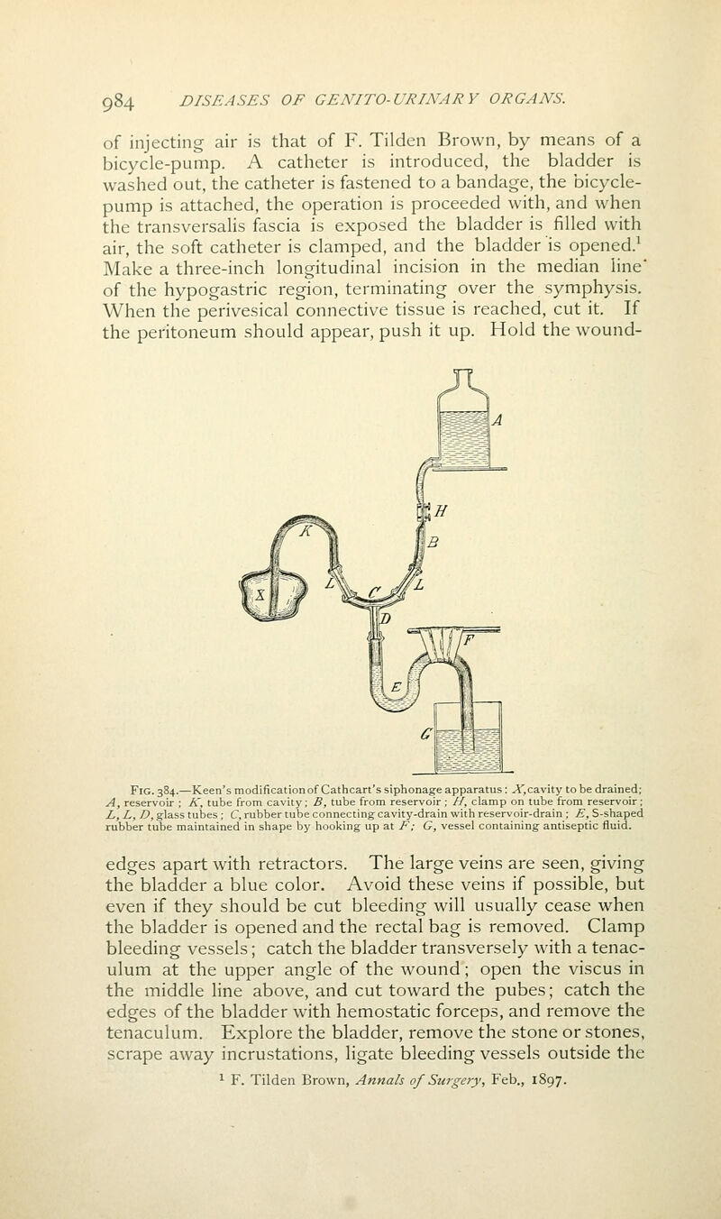 of injecting air is that of F. Tildcn Brown, by means of a bicycle-pump. A catheter is introduced, the bladder is washed out, the catheter is fastened to a bandage, the bicycle- pump is attached, the operation is proceeded with, and when the transversalis fascia is exposed the bladder is filled with air, the soft catheter is clamped, and the bladder is opened.^ Make a three-inch longitudinal incision in the median line' of the hypogastric region, terminating over the symphysis. When the perivesical connective tissue is reached, cut it. If the peritoneum should appear, push it up. Hold the wound- FiG. 384.—Keen's modification of Cathcart's siphonage apparatus: A',cavity to be drained; A, reservoir ; K, tube from cavity; B, tube from reservoir ; //, clamp on tube from reservoir; L, L, D, glass tubes ; C, rubber tube connecting cavity-drain with reservoir-drain ; E, S-shaped rubber tube maintained in shape by hooking up at F; G, vessel containing antiseptic fluid. edges apart with retractors. The large veins are seen, giving the bladder a blue color. Avoid these veins if possible, but even if they should be cut bleeding will usually cease when the bladder is opened and the rectal bag is removed. Clamp bleeding vessels; catch the bladder transversely with a tenac- ulum at the upper angle of the wound; open the viscus in the middle line above, and cut toward the pubes; catch the edges of the bladder with hemostatic forceps, and remove the tenaculum. Explore the bladder, remove the stone or stones, scrape away incrustations, ligate bleeding vessels outside the ^ F. Tilden Brown, Annals of Surgery, Feb., 1897.