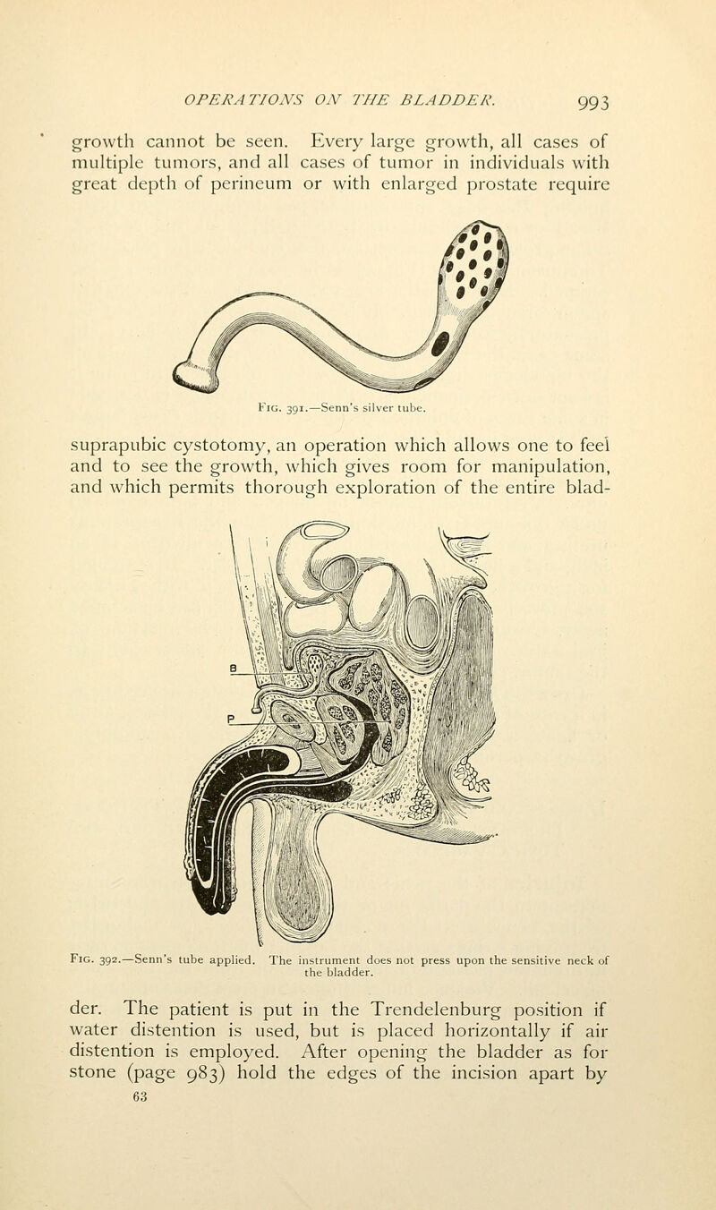 growth cannot be seen. Every large growth, all cases of multiple tumors, and all cases of tumor in individuals with great depth of perineum or with enlarged prostate require Fig. 391.—Senn's silver tube. suprapubic cystotomy, an operation which allows one to feel and to see the growth, which gives room for manipulation, and which permits thorough exploration of the entire blad- FiG. 392.—Senn's tube applied. The instrument does not press upon the sensitive neck of the bladder. der. The patient is put in the Trendelenburg position if water distention is used, but is placed horizontally if air distention is employed. After opening the bladder as for stone (page 983) hold the edges of the incision apart by 63