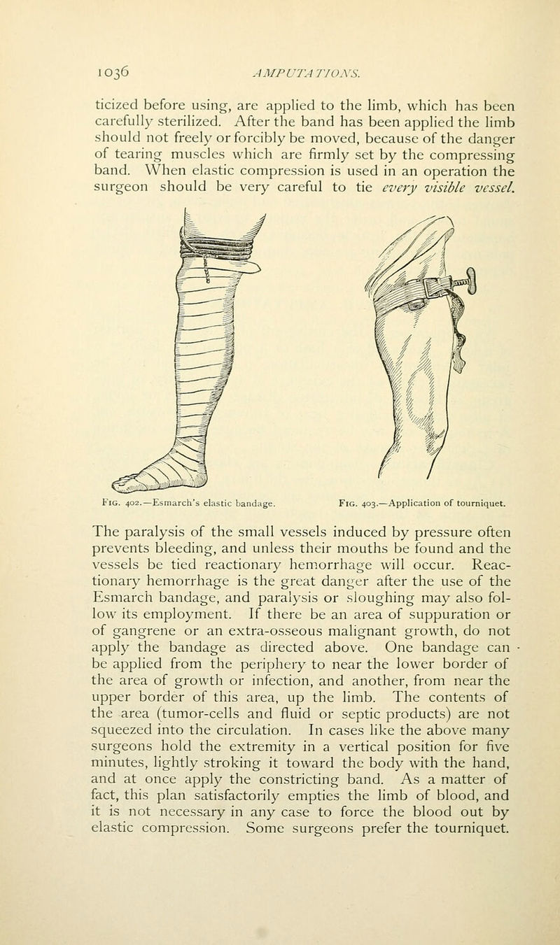 ticized before using, are applied to the limb, which has been carefully sterilized. After the band has been applied the limb should not freely or forcibly be moved, because of the danger of tearing muscles which are firmly set by the compressing band. When elastic compression is used in an operation the surgeon should be very careful to tie every visible vessel. Fig. 402.—Esmarch's elastic bandage. Fig. 403.—Application of tourniquet. The paralysis of the small vessels induced by pressure often prevents bleeding, and unless their mouths be found and the vessels be tied reactionary hemorrhage will occur. Reac- tionary hemorrhage is the great danger after the use of the Esmarch bandage, and paralysis or sloughing may also fol- low its employment. If there be an area of suppuration or of gangrene or an extra-osseous malignant growth, do not apply the bandage as directed above. One bandage can be appHed from the periphery to near the lower border of the area of growth or infection, and another, from near the upper border of this area, up the limb. The contents of the area (tumor-cells and fluid or septic products) are not squeezed into the circulation. In cases like the above many surgeons hold the extremity in a vertical position for five minutes, lightly stroking it toward the body with the hand, and at once apply the constricting band. As a matter of fact, this plan satisfactorily empties the limb of blood, and it is not necessary in any case to force the blood out by elastic compression. Some surgeons prefer the tourniquet.