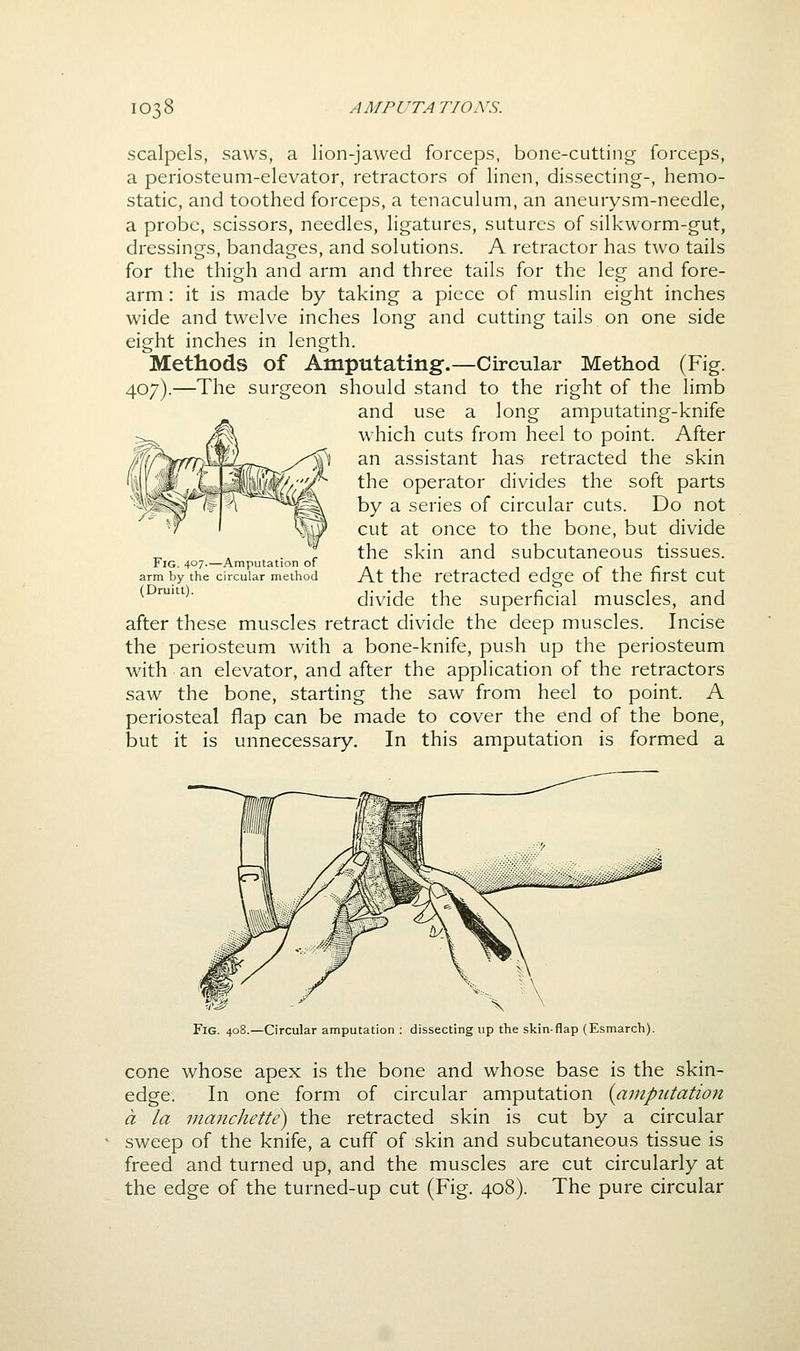 scalpels, saws, a lion-jawed forceps, bone-cutting forceps, a periosteum-elevator, retractors of linen, dissecting-, hemo- static, and toothed forceps, a tenaculum, an aneurysm-needle, a probe, scissors, needles, ligatures, sutures of silkworm-gut, dressings, bandages, and solutions. A retractor has two tails for the thigh and arm and three tails for the leg and fore- arm : it is made by taking a piece of muslin eight inches wide and twelve inches long and cutting tails on one side eight inches in length. Methods of Amputating.—Circular Method (Fig. 407).—The surgeon should stand to the right of the limb and use a long amputating-knife which cuts from heel to point. After an assistant has retracted the skin the operator divides the soft parts by a series of circular cuts. Do not cut at once to the bone, but divide the skin and subcutaneous tissues. At the retracted edge of the first cut divide the superficial muscles, and after these muscles retract divide the deep muscles. Incise the periosteum with a bone-knife, push up the periosteum with an elevator, and after the application of the retractors saw the bone, starting the saw from heel to point. A periosteal flap can be made to cover the end of the bone, but it is unnecessary. In this amputation is formed a Fig. 407.—Amputation of arm by the circular method (Druitt). Fig. 408.—Circular amputation : dissecting up the skin-flap (Esmarch). cone whose apex is the bone and whose base is the skin- edge. In one form of circular amputation {anipiitation a la manchette) the retracted skin is cut by a circular sweep of the knife, a cuff of skin and subcutaneous tissue is freed and turned up, and the muscles are cut circularly at the edge of the turned-up cut (Fig. 408). The pure circular