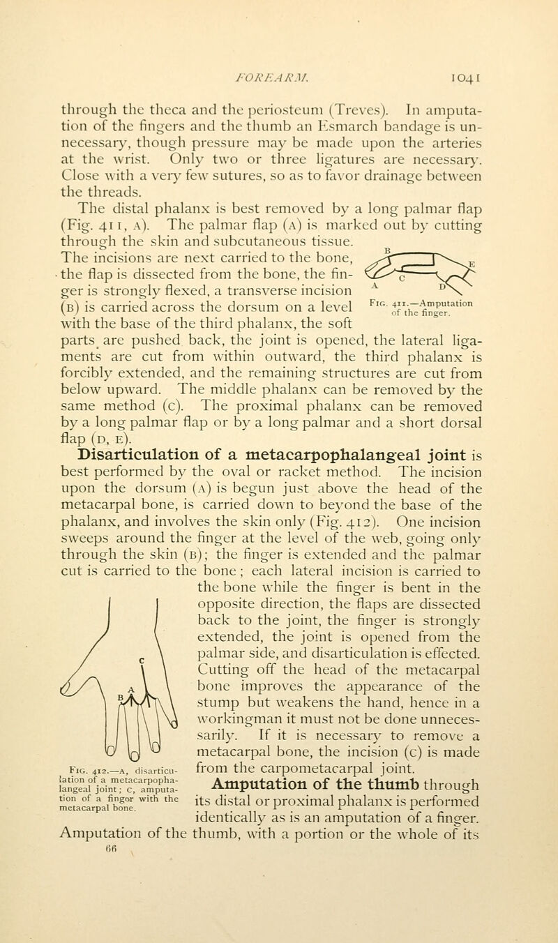 Fig. 411.—Amputation of the finger. through the theca and the periosteum (Treves). In amputa- tion of the fingers and the thumb an Ksmarch bandage is un- necessary, though pressure may be made upon the arteries at the wrist. Only two or three Hgatures are necessar}-. Close with a \&xy few sutures, so as to favor drainage between the threads. The distal phalanx is best removed by a long palmar flap (Fig. 411, a). The palmar flap (a) is marked out by cutting through the skin and subcutaneous tissue. The incisions are next carried to the bone, the flap is dissected from the bone, the fin- ger is strongly flexed, a transverse incision (b) is carried across the dorsum on a level with the base of the third phalanx, the soft parts_ are pushed back, the joint is opened, the lateral liga- ments are cut from within outward, the third phalanx is forcibly extended, and the remaining structures are cut from below upward. The middle phalanx can be removed by the same method (c). The proximal phalanx can be removed by a long palmar flap or by a long palmar and a short dorsal flap (d, e). Disarticulation of a metacarpophalangeal joint is best performed by the oval or racket method. The incision upon the dorsum (.\) is begun just above the head of the metacarpal bone, is carried down to beyond the base of the phalanx, and involves the skin only (Fig. 412). One incision sweeps around the finger at the level of the web, going only through the skin (b); the finger is extended and the palmar cut is carried to the bone ; each lateral incision is carried to the bone while the finger is bent in the opposite direction, the flaps are dissected back to the joint, the finger is strongly extended, the joint is opened from the palmar side, and disarticulation is effected. Cutting off the head of the metacarpal bone improves the appearance of the stump but weakens the hand, hence in a workingman it must not be done unneces- sarily. If it is necessary to remove a metacarpal bone, the incision (c) is made from the carpometacarpal joint. Amputation of the thumb through its distal or proximal phalanx is performed identically as is an amputation of a finger. Amputation of the thumb, with a portion or the whole of its 6fi Fig. 412.—A, disarticu- lation of a metacarpopha- langeal joint; c, amputa- tion of a finger with the metacarpal bone.