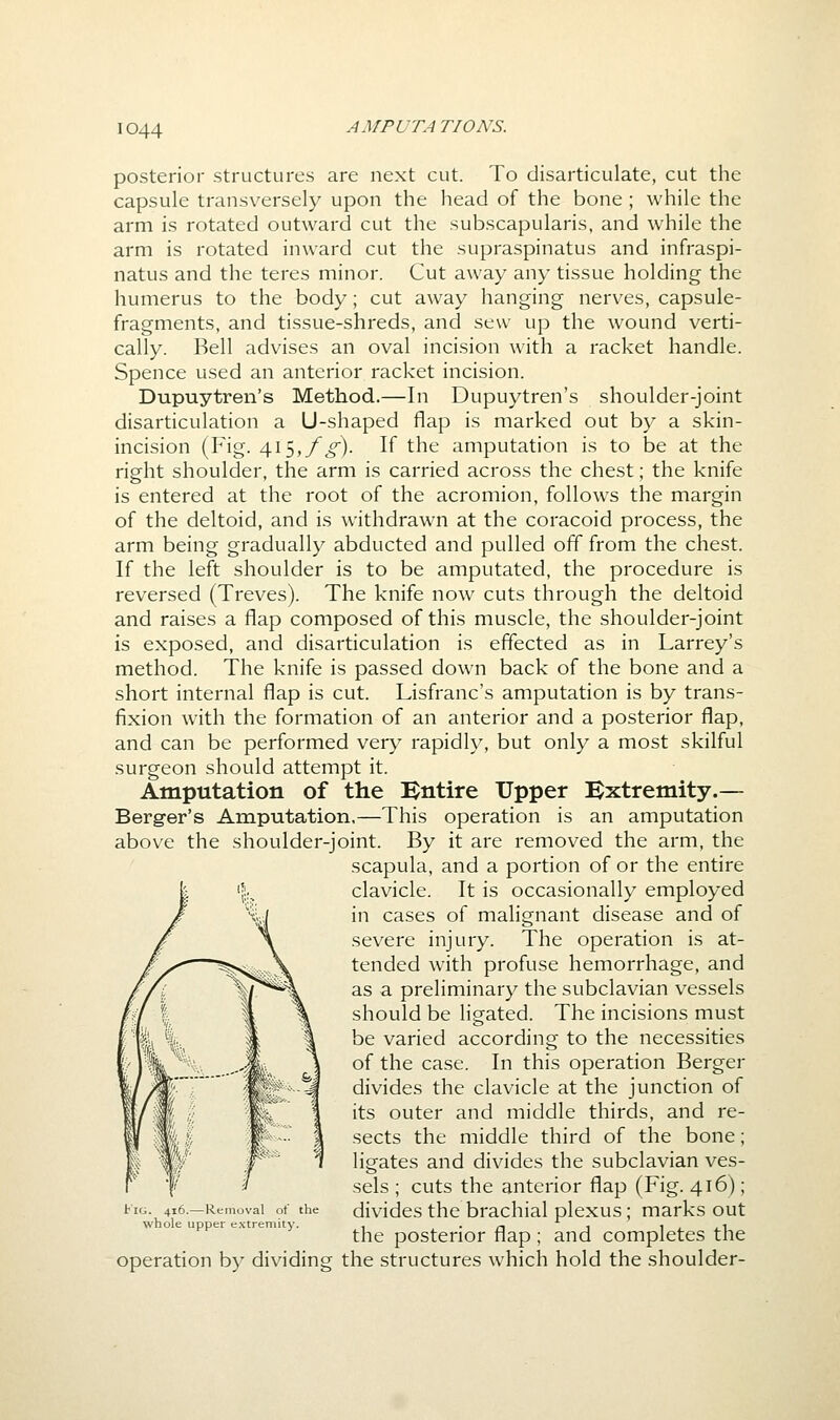 posterior structures are next cut. To disarticulate, cut the capsule transversely upon the head of the bone ; while the arm is rotated outward cut the subscapularis, and while the arm is rotated inward cut the supraspinatus and infraspi- natus and the teres minor. Cut away any tissue holding the humerus to the body; cut away hanging nerves, capsule- fragments, and tissue-shreds, and sew up the wound verti- cally. Bell advises an oval incision with a racket handle. Spence used an anterior racket incision. Dupuytren's Method.—In Dupuytren's shoulder-joint disarticulation a U-shaped flap is marked out by a skin- incision (Fig. 415,/^). If the amputation is to be at the right shoulder, the arm is carried across the chest; the knife is entered at the root of the acromion, follows the margin of the deltoid, and is withdrawn at the coracoid process, the arm being gradually abducted and pulled off from the chest. If the left shoulder is to be amputated, the procedure is reversed (Treves). The knife now cuts through the deltoid and raises a flap composed of this muscle, the shoulder-joint is exposed, and disarticulation is effected as in Larrey's method. The knife is passed down back of the bone and a short internal flap is cut. Lisfranc's amputation is by trans- fixion with the formation of an anterior and a posterior flap, and can be performed very rapidly, but only a most skilful surgeon should attempt it. Amputation of the Bntire Upper Extremity.— Berg-er's Amputation,—This operation is an amputation above the shoulder-joint. By it are removed the arm, the scapula, and a portion of or the entire clavicle. It is occasionally employed in cases of malignant disease and of severe injury. The operation is at- tended with profuse hemorrhage, and as a preliminary the subclavian vessels should be ligated. The incisions must be varied according to the necessities of the case. In this operation Berger divides the clavicle at the junction of its outer and middle thirds, and re- sects the middle third of the bone; ligates and divides the subclavian ves- sels ; cuts the anterior flap (Fig. 416); divides the brachial plexus; marks out the posterior flap ; and completes the operation by dividing the structures which hold the shoulder- t'lG. 416.—Removal of the whole upper extremity.
