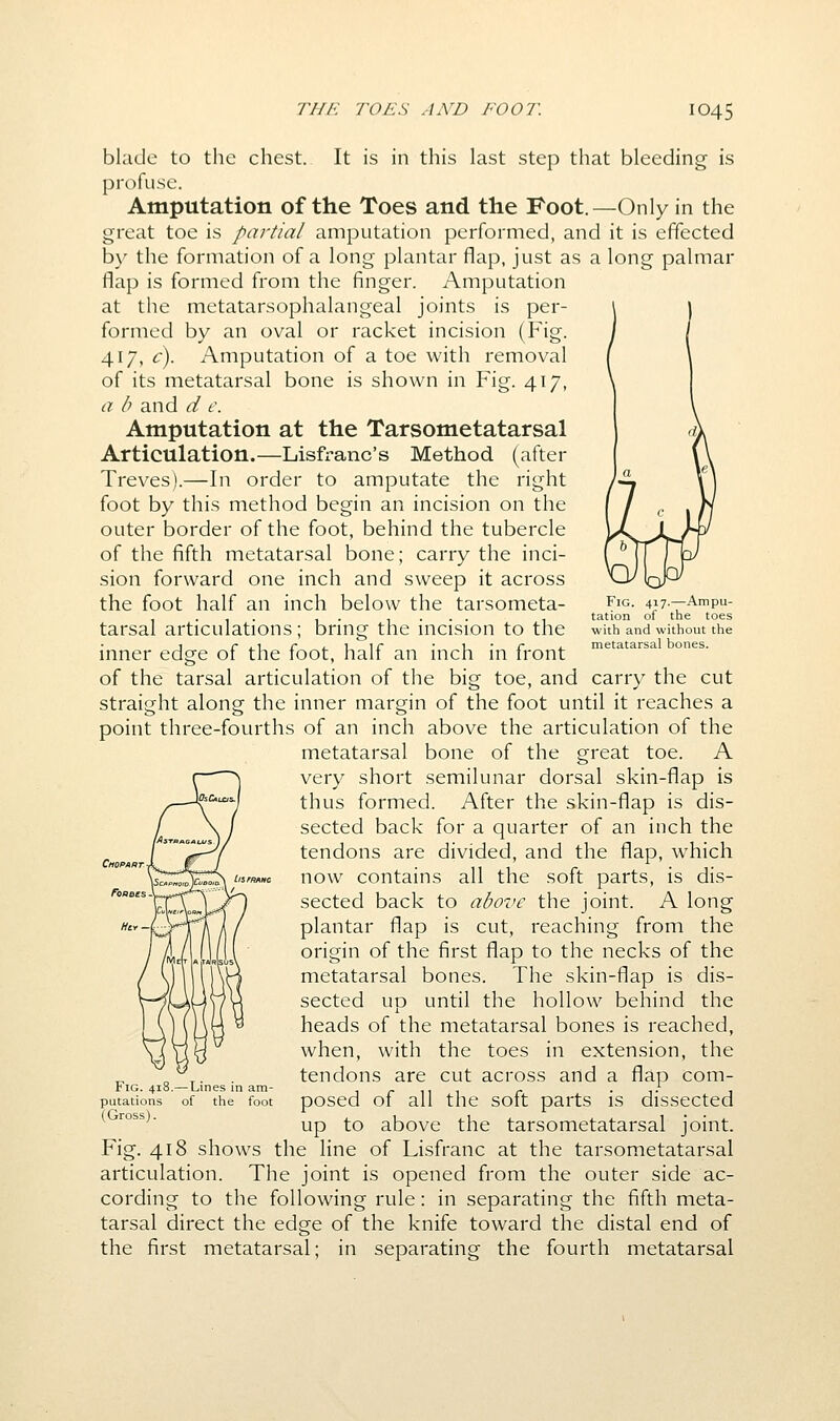 Fig. 417.—Ampu- tation of the toes with and without the metatarsal bones. blade to the chest. It is in this last step that bleeding is profuse. Amputation of the Toes and the Foot.—Only in the great toe is partial amputation performed, and it is effected by the formation of a long plantar flap, just as a long palmar flap is formed from the finger. Amputation at the metatarsophalangeal joints is per- formed by an oval or racket incision (Fig. 417, c). Amputation of a toe with removal of its metatarsal bone is shown in Fig. 417, a b and d c. Amputation at the Tarsometatarsal Articulation.—Lisfranc's Method (after Treves).—In order to amputate the right foot by this method begin an incision on the outer border of the foot, behind the tubercle of the fifth metatarsal bone; carry the inci- sion forward one inch and sweep it across the foot half an inch below the tarsometa- tarsal articulations; bring the incision to the inner edge of the foot, half an inch in front of the tarsal articulation of the big toe, and carry the cut straight along the inner margin of the foot until it reaches a point three-fourths of an inch above the articulation of the metatarsal bone of the great toe. A very short semilunar dorsal skin-flap is thus formed. After the skin-flap is dis- sected back for a quarter of an inch the tendons are divided, and the flap, which now contains all the soft parts, is dis- sected back to above the joint. A long plantar flap is cut, reaching from the origin of the first flap to the necks of the metatarsal bones. The skin-flap is dis- sected up until the hollow behind the heads of the metatarsal bones is reached, when, with the toes in extension, the tendons are cut across and a flap com- posed of all the soft parts is dissected up to above the tarsometatarsal joint. Fig. 418 shows the line of Lisfranc at the tarsometatarsal articulation. The joint is opened from the outer side ac- cording to the following rule: in separating the fifth meta- tarsal direct the edge of the knife toward the distal end of the first metatarsal; in separating the fourth metatarsal Fig. 418.— Lines in am- putations of the foot (Gross).