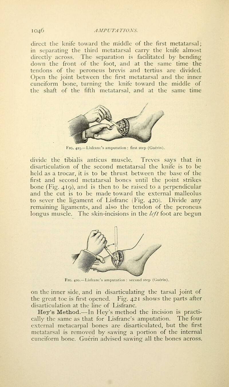 direct the knife toward the middle of the first metatarsal; in separating the third metatarsal carry the knife almost directly across. The separation is facilitated by bending down the front of the foot, and at the same time the tendons of the peroneus brevis and tertius are divided. Open the joint between the first metatarsal and the inner cuneiform bone, turning the knife toward the middle of the shaft of the fifth metatarsal, and at the same time Fig. 419.— Lisfranc's amputation : first step (Guerin). divide the tibialis anticus muscle. Treves says that in disarticulation of the second metatarsal the knife is to be held as a trocar, it is to be thrust between the base of the first and second metatarsal bones until the point strikes bone (Fig. 419), and is then to be raised to a perpendicular and the cut is to be made toward the external malleolus to sever the ligament of Lisfranc (Fig. 420). Divide any remaining ligaments, and also the tendon of the peroneus longus muscle. The skin-incisions in the left foot are begun Fig. 420.—Lisfranc's amputation : second step ((juerin). on the inner side, and in disarticulating the tarsal joint of the great toe is first opened. Fig. 421 shows the parts after disarticulation at the line of Lisfranc. Hey's Method.—In Hey's method the incision is practi- cally the same as that for Lisfranc's amputation. The four external metacarpal bones are disarticulated, but the first metatarsal is removed by sawing a portion of the internal cuneiform bone. Guerin advised sawingf all the bones across.