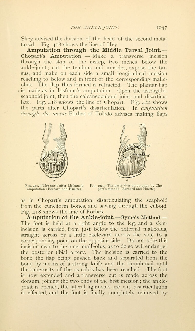 Skey advised the di\-ision of the head of the second meta- tarsal. Fig. 418 shows the hne of Hey. Amputation through the Middle Tarsal Joint.— Chopart's Amputation. — Make a transverse incision through the skin of the instep, two inches below the ankle-joint; cut the tendons and muscles, expose the tar- sus, and make on eacli side a small longitudinal incision reaching to below and in front of the corresponding malle- olus. The flap thus formed is retracted. The plantar flap is made as in Lisfranc's amputation. Open the astragalo- scaphoid joint, then the calcaneocuboid joint, and disarticu- late. Fig. 418 shows the line of Chopart. Fig. 422 shows the parts after Chopart's disarticulation. In anipiitatioii th'oiigJi the tavs2is Forbes of Toledo advises making flaps Fig. 421.—The parts after Lisfranc's amputation (Bernard and Huette). Fig. 422.—The parts after amputation by Cho- part's method (Bernard and Huette). as in Chopart's amputation, disarticulating the scaphoid from the cuneiform bones, and sawing through the cuboid. Fig. 418 shows the line of Forbes. Amputation at the Ankle-joint.—Syme's Method.— The foot is held at a right angle to the leg, and a skin- incision is carried, from just below the external malleolus, straight across or a little backward across the sole to a corresponding point on the opposite side. Do not take this incision near to the inner malleolus, as to do so will endanger the posterior tibial artery. The incision is carried to the bone, the flap being pushed back and separated from the bone by means of a strong knife and the thumb-nail until the tuberosity of the os calcis has been reached. The foot is now extended and a transverse cut is made across the dorsum, joining the two ends of the first incision; the ankle- joint is opened, the lateral ligaments are cut, disarticulation is effected, and the foot is final!}- completely removed b}-