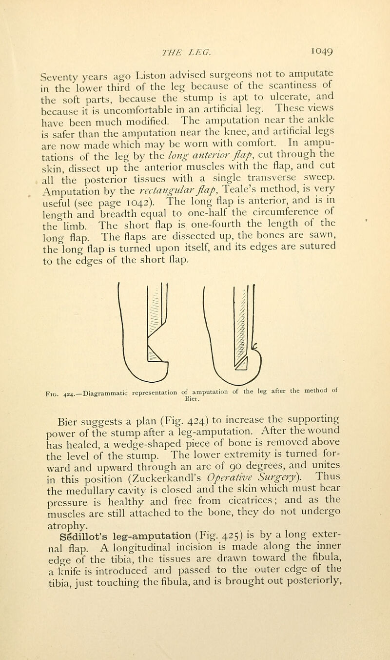 Seventy years ago Liston advised surgeons not to amputate in the lower third of the leg because of the scantiness of the soft parts, because the stump is apt to ulcerate, and because it is uncomfortable in an artificial leg. These views have been much modified. The amputation near the ankle is safer than the amputation near the knee, and artificial legs are now made which may be worn with comfort. In ampu- tations of the leg by the long anterior flap, cut through the skin, dissect up the anterior muscles with the flap, and cut all the posterior tissues with a single transverse sweep. Amputation by the rectangular flap, Teale's method, is very useful (see page 1042). The long flap is anterior, and is in length and breadth equal to one-half the circumference of the limb. The short flap is one-fourth the length of the long flap. The flaps are dissected up, the bones are sawn, thelong flap is turned upon itself, and its edges are sutured to the edges of the short flap. Fig. 424.—Diagrammatic representation of amputation of the leg after the method of Bier. Bier suggests a plan (Fig. 424) to increase the supporting power of the stump after a leg-amputation. After the wound has healed, a wedge-shaped piece of bone is removed above the level of the stump. The lower extremity is turned for- ward and upward through an arc of 90 degrees, and unites in this position (Zuckerkandl's Operative Surgery). Thus the medullary cavity is closed and the skin which must bear pressure is healthy and free from cicatrices; and as the muscles are still attached to the bone, they do not undergo atrophy. Sedillot's leg-amputation (Fig. 425) is by a long exter- nal flap. A longitudinal incision is made along the inner edge of the tibia, the tissues are drawn toward the fibula, a knife is introduced and passed to the outer edge of the tibia, just touching the fibula, and is brought out posteriorly,