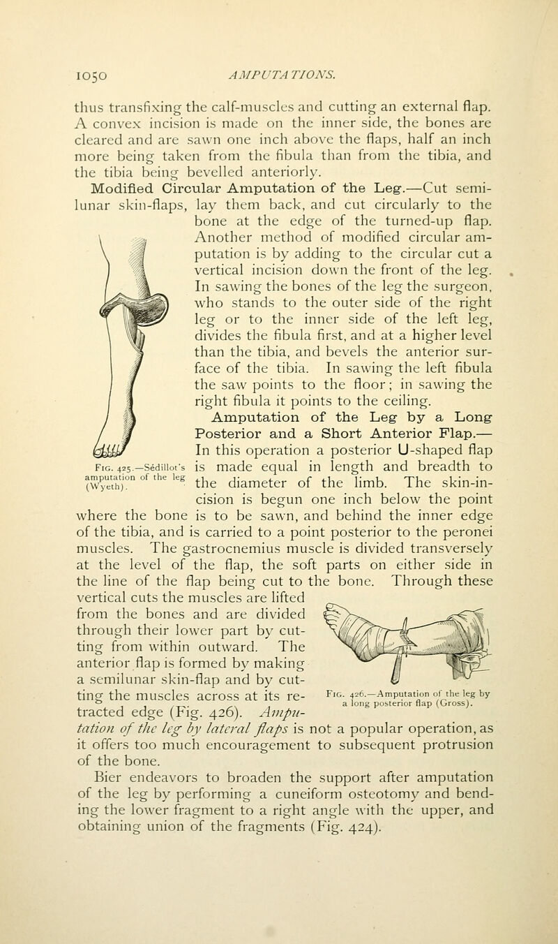 thus transfixing the calf-muscles and cutting an external flap. A convex incision is made on the inner side, the bones are cleared and are sawn one inch above the flaps, half an inch more being taken from the fibula than from the tibia, and the tibia being bevelled anteriorly. Modified Circular Amputation of the Leg.—Cut semi- lunar skin-flaps, lay them back, and cut circularly to the bone at the edge of the turned-up flap. Another method of modified circular am- putation is by adding to the circular cut a vertical incision down the front of the leg. In sawing the bones of the leg the surgeon, who stands to the outer side of the right leg or to the inner side of the left leg, divides the fibula first, and at a higher level than the tibia, and bevels the anterior sur- face of the tibia. In sawing the left fibula the saw points to the floor; in sawing the right fibula it points to the ceiling. Amputation of the Leg- by a Long- Posterior and a Short Anterior Flap.— In this operation a posterior U-shaped flap is made equal in length and breadth to the diameter of the limb. The skin-in- cision is begun one inch below the point where the bone is to be sawn, and behind the inner edge of the tibia, and is carried to a point posterior to the peronei muscles. The gastrocnemius muscle is divided transversely at the level of the flap, the soft parts on either side in the line of the flap being cut to the bone. Through these vertical cuts the muscles are lifted from the bones and are divided through their lower part by cut- ting from within outward. The anterior flap is formed by making a semilunar skin-flap and by cut- ting the muscles across at its re- tracted edge (Fig. 426). Ainpji- tation of tlic leg by lateral flaps is not a popular operation, as it offers too much encouragement to subsequent protrusion of the bone. Bier endeavors to broaden the support after amputation of the leg by performing a cuneiform osteotomy and bend- ing the lower fragment to a right angle with the upper, and obtaining union of the fragments (Fig. 424). Fig. 425.—Sedillot's amputation of the leg (Wyeth). Fig. 426.—Amputation of the leg by a long posterior flap (Gross).