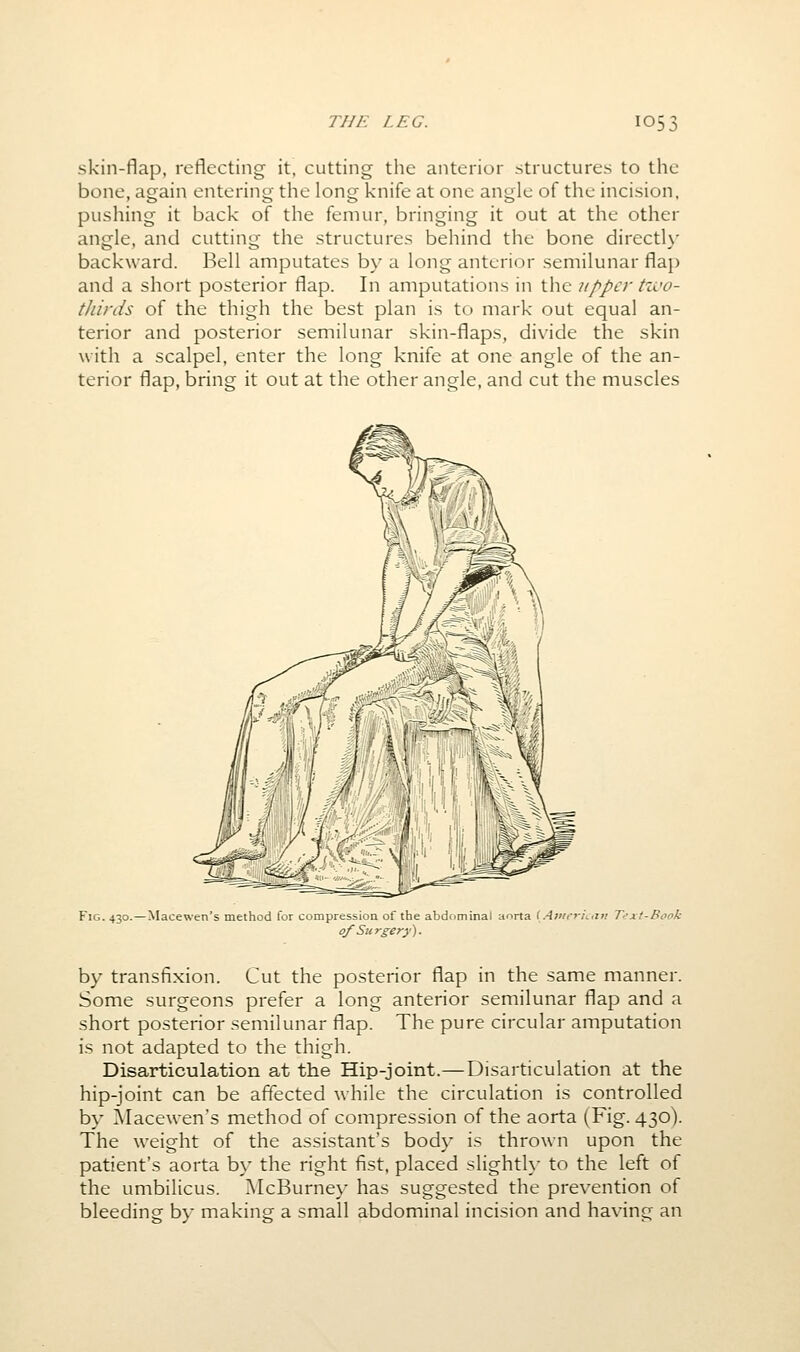 skin-flap, reflecting it, cutting the anterior structures to the bone, again entering the long knife at one angle of the incision, pushing it back of the femur, bringing it out at the other angle, and cutting the structures behind the bone directly backward. Bell amputates by a long anterior semilunar flap and a short posterior flap. In amputations in the upper tzi'o- tliirds of the thigh the best plan is to mark out equal an- terior and posterior semilunar skin-flaps, divide the skin with a scalpel, enter the long knife at one angle of the an- terior flap, bring it out at the other angle, and cut the muscles Fig. 430.—Macewen's method for compression of the abdfiminal anrta (Ai'/rrhari T<^xi-Book of Surgery). by transfixion. Cut the posterior flap in the same manner. Some surgeons prefer a long anterior semilunar flap and a short posterior semilunar flap. The pure circular amputation is not adapted to the thigh. Disarticulation at the Hip-joint.— Disarticulation at the hip-joint can be affected while the circulation is controlled by Macewen's method of compression of the aorta (Fig. 430). The weight of the assistant's body is thrown upon the patient's aorta by the right fist, placed slighth- to the left of the umbilicus. McBurney has suggested the prevention of bleeding by making a small abdominal incision and having an