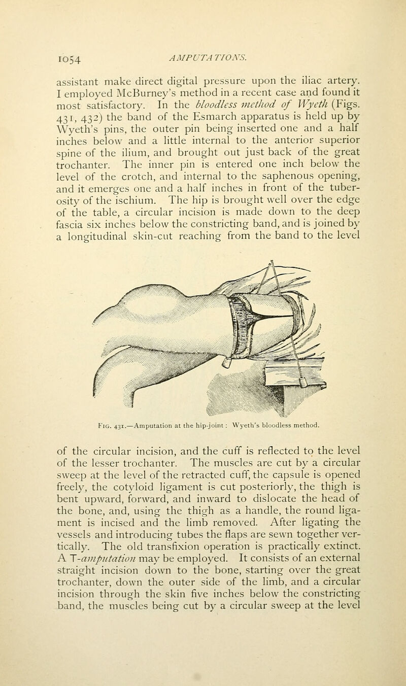 assistant make direct digital pressure upon the iliac artery. I employed McBurney's method in a recent case and found it most satisfactory. In the bloodless method of Wyeth (Figs. 431, 432) the band of the Esmarch apparatus is held up by Wyeth's pins, the outer pin being inserted one and a half inches below and a little internal to the anterior superior spine of the ilium, and brought out just back of the great trochanter. The inner pin is entered one inch below the level of the crotch, and internal to the saphenous opening, and it emerges one and a half inches in front of the tuber- osity of the ischium. The hip is brought well over the edge of the table, a circular incision is made down to the deep fascia six inches below the constricting band, and is joined by a longitudinal skin-cut reaching from the band to the level Fig. 431.—Amputation at the hip-joint: Wyeth's bloodless method. of the circular incision, and the cuff is reflected to the level of the lesser trochanter. The muscles are cut by a circular sweep at the level of the retracted cuff, the capsule is opened freely, the cotyloid ligament is cut posteriorly, the thigh is bent upward, forward, and inward to dislocate the head of the bone, and, using the thigh as a handle, the round hga- ment is incised and the limb removed. After ligating the vessels and introducing tubes the flaps are sewn together ver- tically. The old transfixion operation is practically extinct. A ~[-amputation may be employed. It consists of an external straight incision down to the bone, starting over the great trochanter, down the outer side of the limb, and a circular incision through the skin five inches below the constricting band, the muscles being cut by a circular sweep at the level