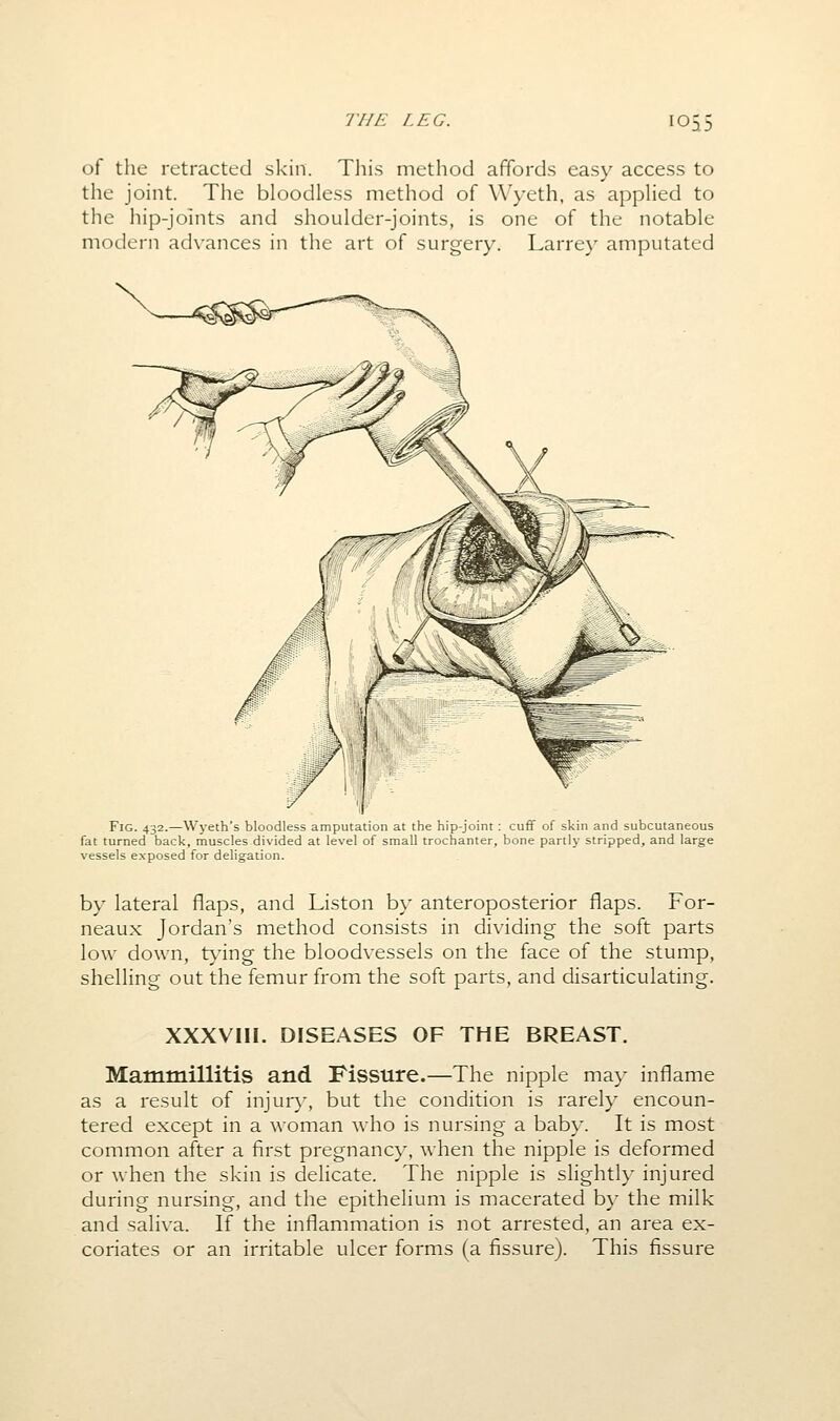 DO of the retracted skin. Tliis method affords easy access to the joint. The bloodless method of Wyeth, as applied to the hip-joints and shoulder-joints, is one of the notable modern advances in the art of surgery. Larrey amputated Fig. 432.—Wyeth's bloodless amputation at the hip joint cuff of skin and subcutaneous fat turned back, muscles divided at level of small trochanter, bone partly stripped, and large vessels exposed for deligation. by lateral flaps, and Liston by anteroposterior flaps. For- neaux Jordan's method consists in dividing the soft parts low down, tying the bloodvessels on the face of the stump, shelling out the femur from the soft parts, and disarticulating. XXXVIII. DISEASES OF THE BREAST. Mammillitis and Fissure.—The nipple may inflame as a result of injur}-, but the condition is rarely encoun- tered except in a woman Avho is nursing a baby. It is most common after a first pregnancy, when the nipple is deformed or when the skin is delicate. The nipple is slightly injured during nursing, and the epithelium is macerated by the milk and saliva. If the inflammation is not arrested, an area ex- coriates or an irritable ulcer forms (a fissure). This fissure