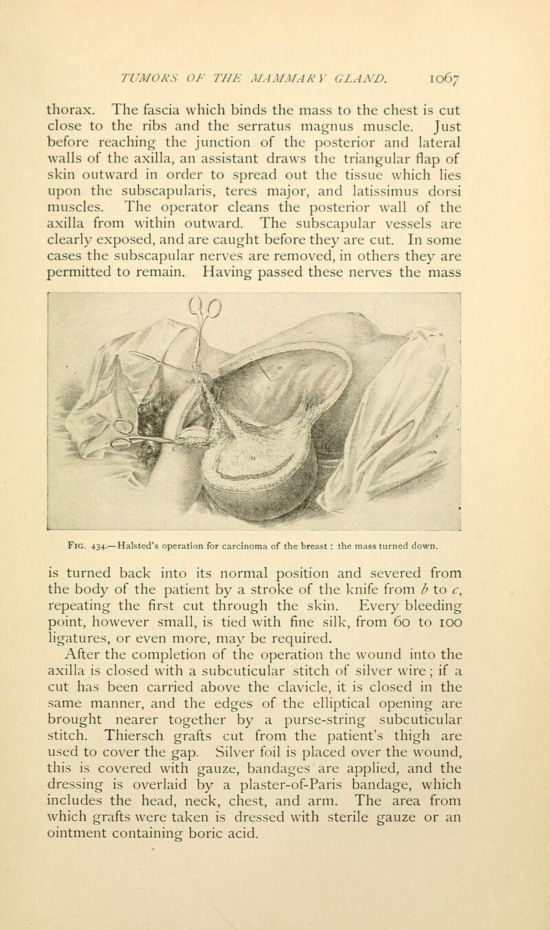 thorax. The fascia which binds the mass to the chest is cut close to the ribs and the serratus magnus muscle. Just before reaching the junction of the posterior and lateral walls of the axilla, an assistant draws the triangular flap of skin outward in order to spread out the tissue which lies upon the subscapularis, teres major, and latissimus dorsi muscles. The operator cleans the posterior wall of the axilla from within outward. The subscapular vessels are clearly exposed, and are caught before they are cut. In some cases the subscapular nerves are removed, in others they are permitted to remain. Having passed these nerves the mass r 00 n .j Fig. 434.—Halsted's operation for carcinoma of the breast: the mass turned down. is turned back into its normal position and severed from the body of the patient by a stroke of the knife from b to c, repeating the first cut through the skin. Every bleeding point, however small, is tied with fine silk, from 60 to 100 ligatures, or even more, may be required. After the completion of the operation the wound into the axilla is closed with a subcuticular stitch of silver wire; if a cut has been carried above the clavicle, it is closed in the same manner, and the edges of the elliptical opening are brought nearer together by a purse-string subcuticular stitch. Thiersch grafts cut from the patient's thigh are used to cover the gap. Silver foil is placed over the wound, this is covered with gauze, bandages are applied, and the dressing is overlaid by a plaster-of-Paris bandage, which includes the head, neck, chest, and arm. The area from which grafts were taken is dressed with sterile gauze or an ointment containine boric acid.