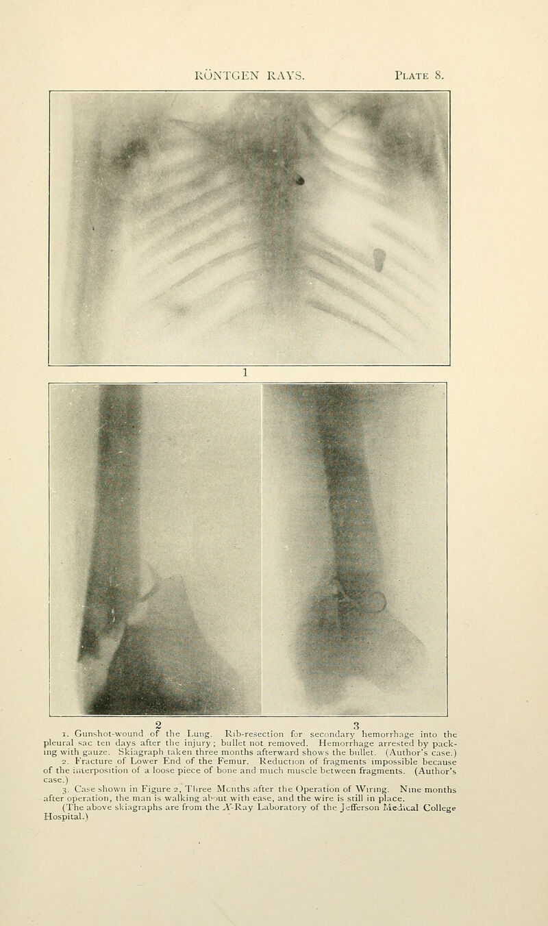KUNTGEN RAYS. Plate S. 2 3 1. Gunshot-wound of the Lung. Rib-re.^ection for secondary hemorrhage into the pleural sac ten days after the injury; bullet not removed. Hemorrhage arrested by pack- ing with gauze. Skiagraph taken three months afterward shows the bullet. (Author's case.) 2. Fracture of Lower End of the Femur. Reduction of fragments impossible because of the iiiierposition of a loose piece of bone and much muscle between fragments. (Author's case.) 3. Case shown in Figure 2, Three Months after the Operation of Wiring. Nine months after operation, the man is walking about with ease, and the wire is still in place. (The above skiagraphs are from the A'-Ray Laboratory of the Jefferson Medical College Hospital. \