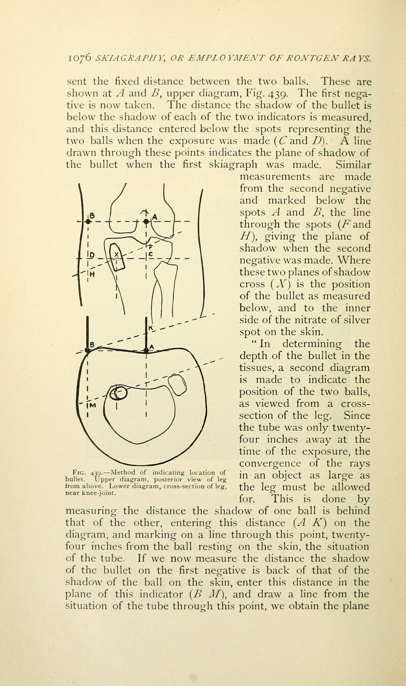 sent the fixed distance between the two balls. These are shown at A and B, upper diagram, Fig. 439. The first nega- tive is now taken. The distance the shadow of the bullet is below the shadow of each of the two indicators is measured, and this distance entered below the spots representing the two balls when the exposure was made (6'and D). A line drawn through these points indicates the plane of shadow of the bullet when the first skiagraph was made. Similar measurements are made from the second negative and marked below the spots A and B, the line through the spots (/^and //), giving the plane of shadow when the second negative was made. Where these two planes of shadow cross (^Y) is the position of the bullet as measured below, and to the inner side of the nitrate of silver spot on the skin.  In determining the depth of the bullet in the tissues, a second diagram is made to indicate the position of the two balls, as viewed from a cross- section of the leg. Since the tube was only twenty- four inches away at the time of the exposure, the convergence of the rays in an object as large as the leg must be allowed for. This is done by measuring the distance the shadow of one ball is behind that of the other, entering this distance {A K) on the diagram, and marking on a line through this point, twenty- four inches from the ball resting on the skin, the situation of the tube. If we now measure the distance the shadow of the bullet on the first negative is back of that of the shadow of the ball on the skin, enter this distance in the plane of this indicator [B M), and draw a line from the situation of the tube through this point, we obtain the plane Fig. 439.—.Method of indicating location of bullet. Upper diagram, posterior view of leg from above. Lower diagram, cross-section of leg, near knee-joint.