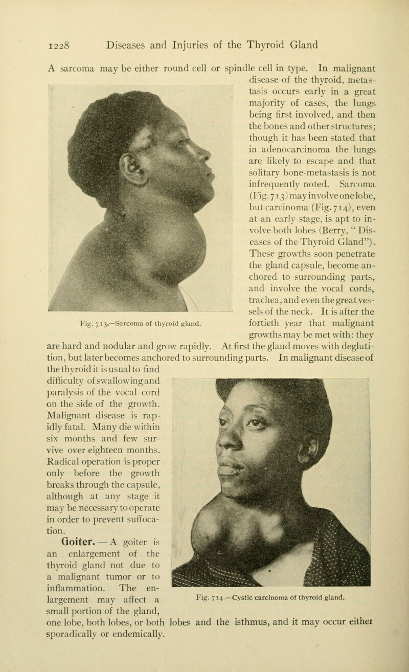 Fig. 7131—Sarcoma of thyroiii Rlaiid. A sarcoma may be either round cell or spindle cell in type. In malignant disease of the thyroid, metas- tasis occurs early in a great majority of cases, the lungs being first involved, and then the bones and other structures; though it has been stated that in adenocarcinoma the lungs are likely to escape and that soHtary bone-metastasis is not infrequently noted. Sarcoma (Fig. 713) may involve one lobe, but carcinoma (Fig. 714), even at an early stage, is apt to in- volve both lobes (Berry,  Dis- eases of the Thyroid Gland). Tliese growths soon penetrate the gland capsule, become an- chored to surrounding parts, and involve the vocal cords, trachea, and even the great ves- sels of the neck. It is after the fortieth year that malignant growths may be met with: they are hard and nodular and grow rapidly. At first the gland moves with degluti- tion, but later becomes anchored to surrounding parts. In malignant disease of the thyroid it is usual to find difficulty of swallowing and paralysis of the vocal cord on the side of the growth. Malignant disease is rap- idly fatal. Many die within six months and few sur- vive over eighteen months. Radical operation is proper only before the growth breaks through the capsule, although at any stage it may be necessary to operate in order to prevent sufi'oca- tion. Goiter. — A goiter is an enlargement of the thyroid gland not due to a malignant tumor or to inflammation. The en- largement may affect a small portion of the gland, one lobe, both lobes, or both lobes and the isthmus, and it may occur eithei sporadically or endemically. Fig. 714.—Cystic carcinoma of thyroid gland.