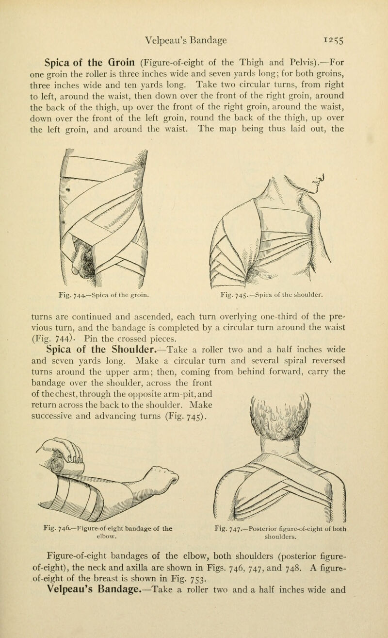 Velpeau's Bandage iz'^S Spica of the Groin (Figure-of-eight of the Thigh and Pelvis).—For one groin the roller is three inches wide and seven yards long; for both groins, three inches wide and ten yards long. Take two circular turns, from right to left, around the waist, then down over the front of the right groin, around the back of the thigh, up over the front of the right groin, around the waist, down over the front of the left groin, round the back of the thigh, up over the left groin, and around the waist. The map being thus laid out, the Fig. 744.—Spica of the groin. Fig. 745.—Spica of the shoulder. turns are continued and ascended, each turn overlying one-third of the pre- vious turn, and the bandage is completed by a circular turn around the waist (Fig. 744)- Pin the crossed pieces. Spica of the Shoulder.—Take a roller two and a half inches wide and seven yards long. Make a circular turn and several spiral reversed turns around the upper arm; then, coming from behind forward, carry the bandage over the shoulder, across the front of the chest, through the opposite arm-pit, and . .^> return across the back to the shoulder. Make IriJ, successive and advancing turns (Fig. 745). HlVi! Fig. 746.—Figure-of-eight bandage of the elbow. Fig. 747.—Posterior figure-of-eight of both shoulders. Figure-of-eight bandages of the elbow, both shoulders (posterior figure- of-eight), the neck and axilla are shown in Figs. 746, 747, and 748. A figure;- of-eight of the breast is shoMOi in Fig. 753. Velpeau's Bandage.—Take a roller two and a half inches wide and