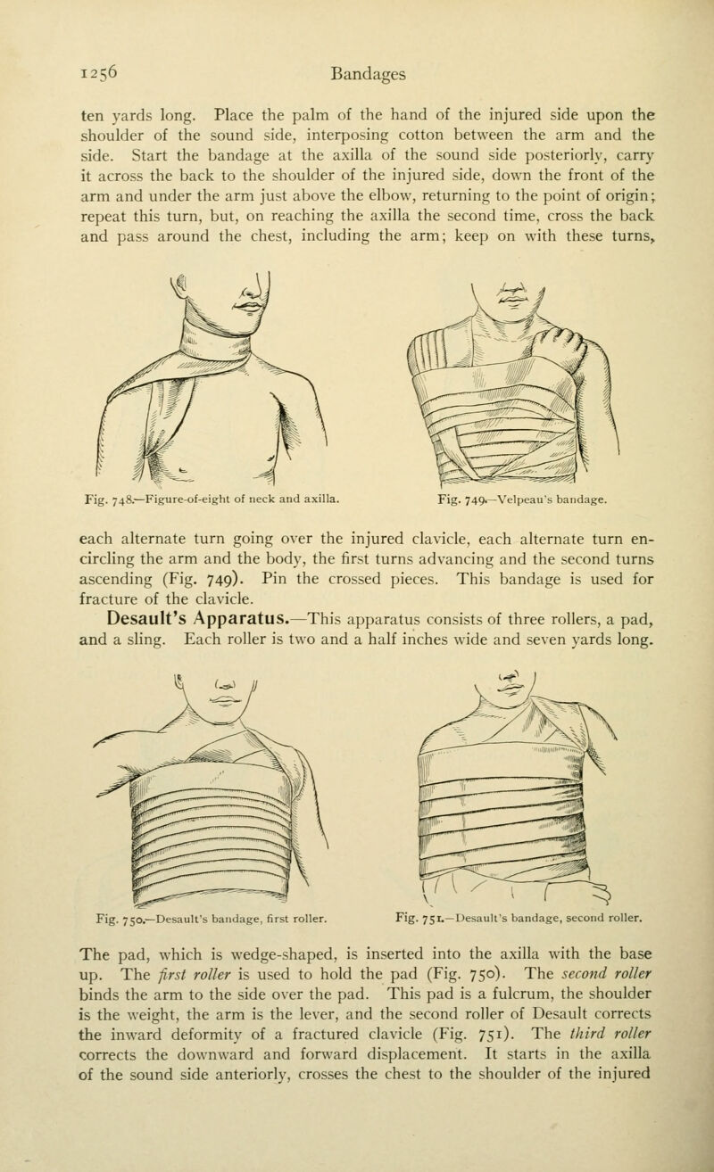 ten yards long. Place the palm of the hand of the injured side upon the shoulder of the sound side, interposing cotton between the arm and the side. Start the bandage at the axilla of the sound side posteriorly, carry it across the back to the shoulder of the injured side, down the front of the arm and under the arm just above the elbow, returning to the point of origin; repeat this turn, but, on reaching the axilla the second time, cross the back and pass around the chest, including the arm; keep on with these turns. Fig. 748.—Figure-of-eight of neck and axilla. Fig. 749.—Velpeau's bandage. each alternate turn going over the injured clavicle, each alternate turn en- circling the arm and the body, the first turns advancing and the second turns ascending (Fig. 749). Pin the crossed pieces. This bandage is used for fracture of the clavicle. Desault's Apparatus.—This apparatus consists of three rollers, a pad, and a sling. Each roller is two and a half inches wide and seven yards long. Fig. 750.—Desault's bandage, first roller. \ ^ 1 ^; Fig. 751.—Desault's bandage, second roller. The pad, which is wedge-shaped, is inserted into the axilla with the base up. The first roller is used to hold the pad (Fig. 750). The second roller binds the arm to the side over the pad. This pad is a fulcrum, the shoulder is the weight, the arm is the lever, and the second roller of Desault corrects the inward deformity of a fractured clavicle (Fig. 751). The third roller corrects the downward and forward displacement. It starts in the axilla of the sound side anteriorly, crosses the chest to the shoulder of the injured