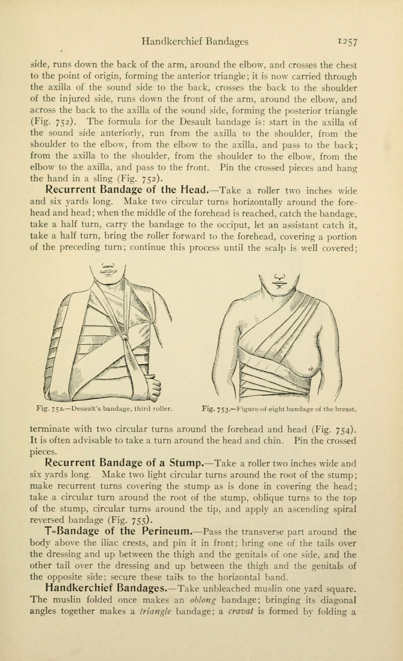side, runs down the back of the arm, around the elbow, and crosses the chest to the point of origin, forming the anterior triangle; it is now carried through the axilla of the sound side to the back, crosses the back to the shoulder of the injured side, runs down the front of the arm, around the elbow, and across the back to the axilla of the sound side, forming the posterior triangle (Fig. 752). The formula for the Desault bandage is: start in the axilla of the sound side anteriorly, run from the axilla to the shoulder, from the shoulder to the elbow, from the elbow to the axilla, and pass to the back; from the axilla to the shoulder, from the shoulder to the elbow, from the elbow to the axilla, and pass to the front. Pin the crossed pieces and hang the hand in a sling (Fig. 752). Recurrent Bandage of the Head.—Take a roller two inches wide and six yards long. Make two circular turns horizontally around the fore- head and head; when the middle of the forehead is reached, catch the bandage, take a half turn, carry the bandage to the occiput, let an assistant catch it, take a half turn, bring the roller forward to the forehead, covering a portion of the preceding turn; continue this process until the scalp is well covered; Fig. 752.—Desault's bandage, third roller. Fig. 753.—Figure-of-eight bandage of the breast. terminate with two circular turns around the forehead and head (Fig. 754). It is often advisable to take a turn around the head and chin. Pin the crossed pieces. Recurrent Bandage of a Stump.—Take a roller two inches wide and six yards long. Make two light circular turns around the root of the stump; make recurrent turns covering the stump as is done in covering the head; take a circular turn around the root of the stump, oblique turns to the top of the stump, circular turns around the tip, and apply an ascending spiral reversed bandage (Fig. 755). T=Bandage of the Perineum.—Pass the transverse part around the body above the iliac crests, and pin it in front: bring one of the tails over the dressing and up between the thigh and the genitals of one side, and the other tail over the dressing and up between the thigh and the genitals of the opposite side: secure these tails to the horizontal band. Handkerchief Bandages.—Take unbleached mushn one yard square. The muslin folded once makes an oblong bandage; bringing its diagonal angles together makes a triangle bandage; a cravat is formed by folding a