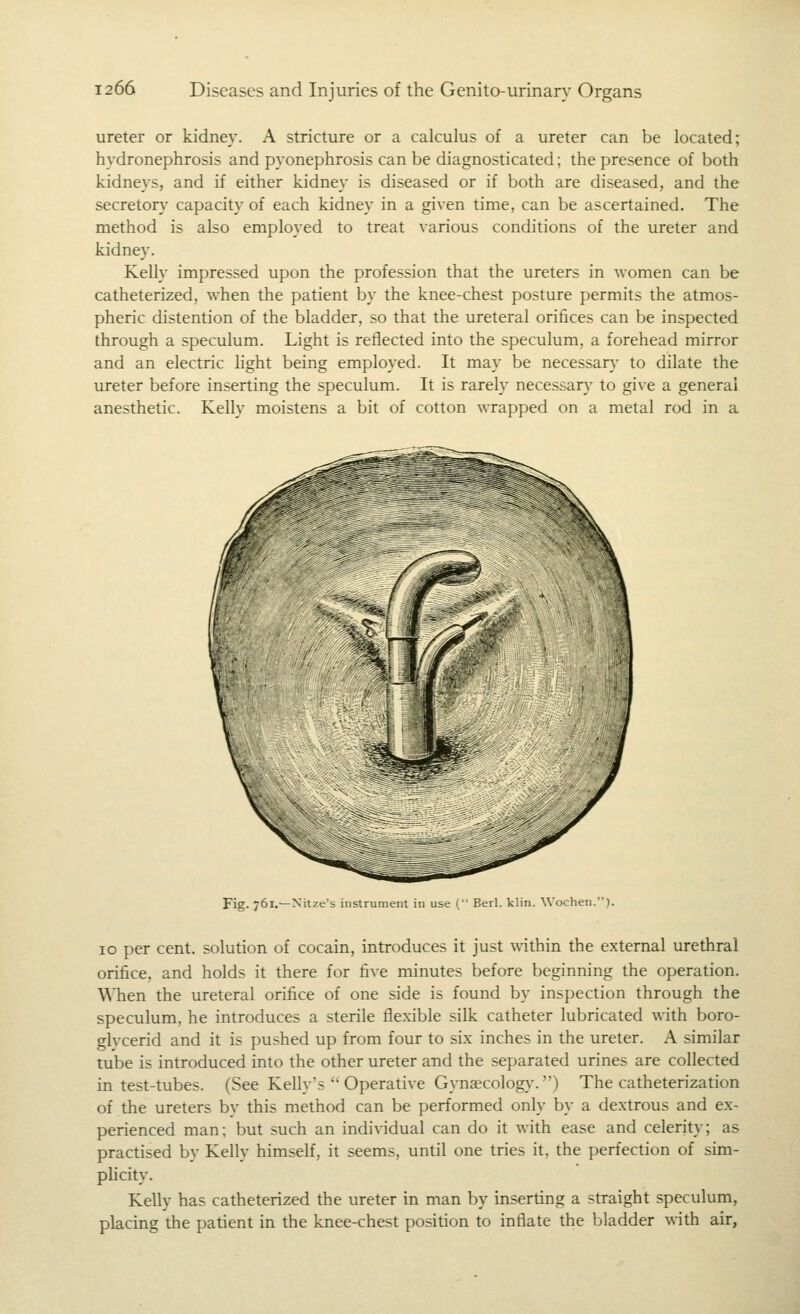 ureter or kidney. A stricture or a calculus of a ureter can be located; hydronephrosis and pyonephrosis can be diagnosticated; the presence of both kidneys, and if either kidney is diseased or if both are diseased, and the secretory capacity of each kidney in a given time, can be ascertained. The method is also employed to treat various conditions of the ureter and kidney. Kelly impressed upon the profession that the ureters in women can be catheterized, when the patient by the knee-chest posture permits the atmos- pheric distention of the bladder, so that the ureteral orifices can be inspected through a speculum. Light is reflected into the speculum, a forehead mirror and an electric light being employed. It may be necessary to dilate the ureter before inserting the speculum. It is rarely necessary to give a general anesthetic. Kelly moistens a bit of cotton wrapped on a metal rod in a Fig. 761.—Nitze's instrument in use ( Berl. klin. Wochen.). 10 per cent, solution of cocain, introduces it just \\'ithin the external urethral orifice, and holds it there for five minutes before beginning the operation. WTien the ureteral orifice of one side is found by inspection through the speculum, he introduces a sterile flexible silk catheter lubricated with boro- glvcerid and it is pushed up from four to six inches in the ureter. A similar tube is introduced into the other ureter and the separated urines are collected in test-tubes. (See Kelly's *'Operative Gyna?colog}-.) The catheterization of the ureters by this method can be performed only by a dextrous and ex- perienced man; but such an individual can do it with ease and celerity; as practised by Kelly himself, it seems, until one tries it, the perfection of sim- pUcity. Kelly has catheterized the ureter in man by inserting a straight speculum, placing the patient in the knee-chest position to inflate the bladder with air,