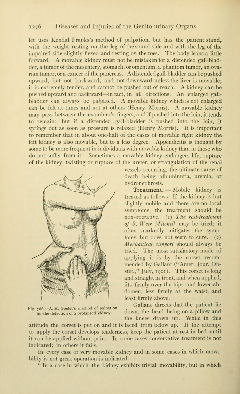 let uses Kendal Franks's method of palpation, but has the patient stand, with the weight resting on the leg of the sound side and with the leg of the impaired side sHghtly flexed and resting on the toes. The body leans a little forward. A movable kidney must not be mistaken for a distended gall-blad- der, a tumor of the mesentery, stomach, or omentum, a phantom tumor, an ova- rian tumor, or a cancer of the pancreas. A distended gall-bladder can be pushed upward, but not backward, and not downward unless the liver is movable;^ it is extremely tender, and cannot be pushed out of reach. A kidney can be pushed upward and backward^n fact, in all directions. An enlarged gall- bladder can always be palpated. A movable kidney which is not enlarged can be felt at times and not at others (Henry AIorris). A movable kidney may pass between the examiner's fingers, and if pushed into the loin, it tends to remain; but if a distended gall-bladder is pushed into the loin, it springs out as soon as pressure is relaxed (Henry Morris). It is important to remember that in about one-half of the cases of movable right kidney the left kidney is also movable, but to a less degree. Appendicitis is thought by some to be more frequent in individuals with movable kidney than in those who do not suffer from it. Sometimes a movable kidney endangers life, rupture of the kidney, twisting or rupture of the ureter, or strangulation of the renal vessels occurring, the uldmate cause of death being albuminuria, uremia, or hydronephrosis. Treatment. — Mobile kidney is treated as follows: If the kidney is but slightly mobile and there are no local symptoms, the treatment should be non-operative, (i) The rest-treatment of S. Weir Mitchell may be tried; it often markedly mitigates the symp- toms, but does not seem to cure. (2) Mechanical support should always be tried. The most satisfactory mode of apphing it is by the corset recom- mended by Gallant (Amer. Jour. Ob- stet., July, iQoi). This corset is long and straight in front, and when apphed, fits firmly over the hips and lower ab- domen, less firmly at the waist, and least firmly above. Gallant directs that the patient lie down, the head being on a pillow and the knees drawn up. While in this attitude the corset is put on and it is laced from below up. If the attempt to apply the corset develops tenderness, keep the padent at rest in bed until it can be applied without pain. In some cases conservative treatment is not indicated; in others it fails. In every case of very movable kidney and in some cases in which mova- bility is not great operation is indicated.  In a case in which the kidney exhibits trivial raovability, but in which Fig. 766.—A. H. Goelet's method of palpation tor the detection of a prolapsed kidney.