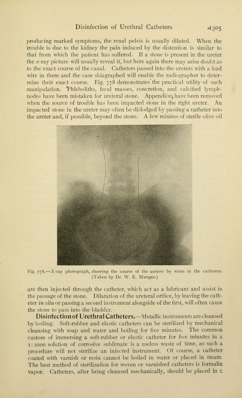 Disinfection of Urethral Catheters ^^S^S producing marked symptoms, the renal pelvis is usually dilated. When the trouble is due to the kidney the pain induced by the distention is similar to that from which the padent has suffered. If a stone is present in the ureter the a-ray picture will usually reveal it, but here again there may arise doubt as to the exact course of the canal. Catheters f)assed into the ureters with a lead wire in them and the case skiagraphed will enable the radiographer to deter- mine their exact course. Fig. 778 demonstrates the practical utility of such manipulation. *Phleboliths, fecal masses, concretion, and calcified lymph- nodes have been mistaken for ureteral stone. Appendices have been removed when the source of trouble has been impacted stone in the right ureter. An impacted stone in the ureter may often be dislodged by y)assing a catheter into the ureter and, if possible, beyond the stone. A few minims of sterile olive oil Fig. 778.—X-ray photograph, showing the course of the ureters by wires in the catheters. (Taken by Dr. W. E. Manges.) are then injected through the catheter, which act as a lubricant and assist in the passage of the stone. Dilatation of the ureteral orifice, by leaving the cath- eter in situ or passing a second instrument alongside of the first, will often cause the stone to pass into the bladder. Disinfection of Urethral Catheters.—MetaUic instruments are cleansed by boiling. Soft-rubber and elastic catheters can be sterihzed by mechanical cleansing with soap and water and boiling for five minutes. The common custom of immersing a soft-rubber or elasdc catheter for five minutes in a 1: 2000 solution of corrosive subUmate is a useless waste of time, as such a procedure will not sterilize an infected instrument. Of course, a catheter coated with varnish or resin cannot be boiled in water or placed in steam. The best method of sterilization for woven or varnished catheters is formalin vapor. Catheters, after being cleansed mechanically, should be placed in ?.