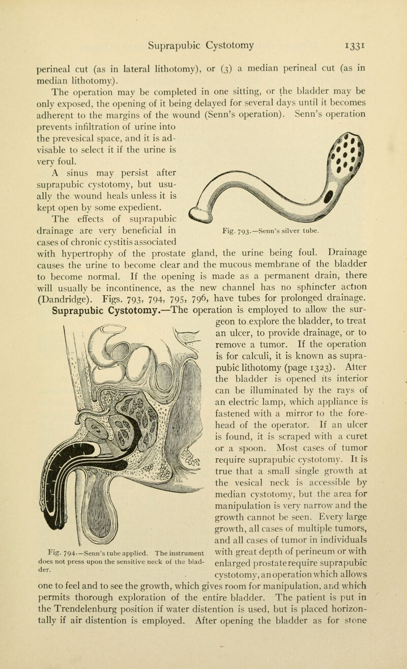 Fig. 793.—Senn's silver tube. perineal cut (as in lateral lithotomy), or (3) a median perineal cut (as in median lithotomy). The operation may be completed in one sitting, or the bladder may be only exposed, the opening of it being delayed for several days until it becomes adherent to the margins of the wound (Senn's operation). Senn's operation prevents infiltration of urine into the prevesical space, and it is ad- visable to select it if the urine is very foul. A sinus may persist after suprapubic cystotomy, but usu- ally the wound heals unless it is kept open by some expedient. The effects of suprapubic drainage are very beneficial in cases of chronic cystitis associated with hypertrophy of the prostate gland, the urine being foul. Drainage causes the urine to become clear and the mucous membrane of the bladder to become normal. If the opening is made as a permanent drain, there will usually be incontinence, as the new channel has no sphincter action (Dandridge). Figs. 793, 794, 795, 79^, have tubes for prolonged drainage. Suprapubic Cystotomy.—The operation is employed to allow the sur- geon to explore the bladder, to treat an ulcer, to provide drainage, or to remove a tumor. If the operation is for calculi, it is known as supra- pubic lithotomy (page 1323). Atter the bladder is opened its interior can be illuminated by the rays of an electric lamp, which appliance is fastened with a mirror to the fore- head of the operator. If an ulcer is found, it is scraped with a curet or a spoon. Most cases of tumor require suprapubic cystotomy. It is true that a small single growth at the vesical neck is accessible by median cystotomy, but the area for manipulation is very narrow and the growth cannot be seen. Every large growth, all cases of multiple tumors, and all cases of tumor in individuals with great depth of perineum or with enlarged prostate require suprapubic cystotomy, an operation which allows one to feel and to see the growth, which gives room for manipulation, and which permits thorough exploration of the entire bladder. The patient is put in the Trendelenburg position if water distention is used, but is placed horizon- tally if air distention is employed. After opening the bladder as for stone Fig- 794—Senn's tube applied. The instrument does not press upon the sensitive neck of the blad- der.