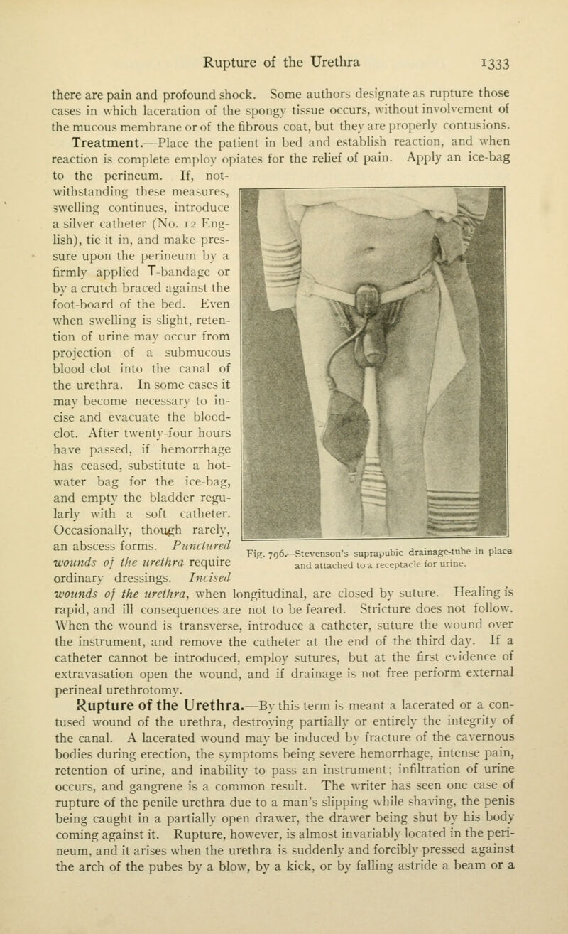 there are pain and profound shock. Some authors designate as rupture those cases in which laceration of the spongy tissue occurs, without invohement of the mucous meml:)rane or of the fibrous coat, but they are properly contusions. Treatment.—Place the patient in bed and establish reaction, and when reaction is complete employ opiates for the relief of pain. Apply an ice-bag to the perineum. If, not- withstanding these measures, swelling continues, introduce a silver catheter (No. 12 Eng- lish), tie it in, and make pres- sure upon the perineum by a firmly applied T-bandage or by a crutch braced against the foot-board of the bed. Even w^hen swelling is slight, reten- tion of urine may occur from projection of a submucous blood-clot into the canal of the urethra. In some cases it may become necessary to in- cise and evacuate the blocd- clot. After twenty-four hours have passed, if hemorrhage has ceased, substitute a hot- water bag for the ice-bag, and empty the bladder regu- larly with a soft catheter. Occasionally, though rarely, an abscess forms. Pimctund wounds of the urethra require ordinary dressings. Incised wounds of the urethra, when longitudinal, are closed by suture. Healing is rapid, and ill consequences are not to be feared. Stricture does not follow. When the wound is transverse, introduce a catheter, suture the wound over the instrument, and remove the catheter at the end of the third day. If a catheter cannot be introduced, employ sutures, but at the first evidence of extravasation open the wound, and if drainage is not free perform external perineal urethrotomy. Rupture of the Urethra.—By this term is meant a lacerated or a con- tused wound of the urethra, destroying partially or entirely the integrity of the canal. A lacerated wound may be induced by fracture of the cavernous bodies during erection, the symptoms being severe hemorrhage, intense pain, retention of urine, and inability to pass an instrument; infiltration of urine occurs, and gangrene is a com.mon result. The writer has seen one case of rupture of the penile urethra due to a man's shpping while shaving, the penis being caught in a partially open drawer, the drawer being shut by his body coming against it. Rupture, how-ever, is almost invariably located in the peri- neum, and it arises when the urethra is suddenly and forcibly pressed against the arch of the pubes by a blow, by a kick, or by falling astride a beam or a Fig. 796.—Stevenson's suprapubic drainage-tube in place and attached to a receptacle for urine.