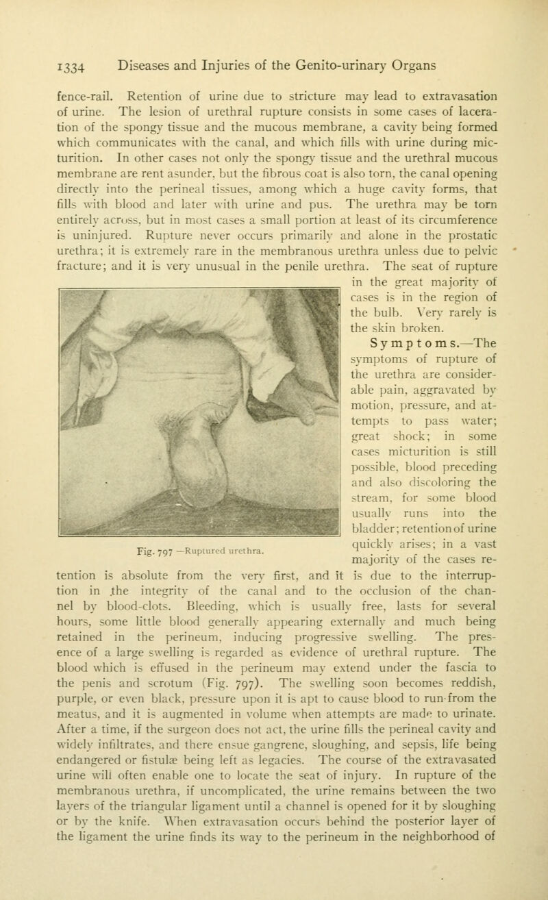 fence-rail. Retention of urine due to stricture may lead to extravasation of urine. The lesion of urethral rupture consists in some cases of lacera- tion of the spongy tissue and the mucous membrane, a cavity being formed which communicates with the canal, and which fills with urine during mic- turition. In other cases not only the spongy tissue and the urethral mucous membrane are rent asunder, but the fibrous coat is also torn, the canal opening directly into the perineal tissues, among which a huge cavity forms, that fills with blood and later with urine and pus. The urethra may be torn entirely across, but in most cases a small portion at least of its circumference is uninjured. Rupture never occurs primarily and alone in the prostatic urethra; it is extremely rare in the membranous urethra unless due to pelvic fracture; and it is very unusual in the penile urethra. The seat of rupture in the great majority of cases is in the region of the bulb. \'ery rarely is the skin broken. Symptom s.—The symptoms of rupture of the urethra are consider- able pain, aggravated by motion, pressure, and at- tempts to pass water; great shock; in some cases micturition is still possible, blood preceding and also discoloring the stream, for some blood usually runs into the bladder; retention of urine quickly arises; in a vast majorit3' of the cases re- tention is absolute from the very first, and it is due to the interrup- tion in .the integrity of the canal and to the occlusion of the chan- nel by blood-clots. Bleeding, which is usually free, lasts for several hours, some little blood generally appearing externally and much being retained in the perineum, inducing progressive swelling. The pres- ence of a large swelhng is regarded as evidence of urethral rupture. The blood which is eftused in the perineum may extend under the fascia to the penis and scrotum (Fig. 797). The swelling soon becomes reddish, purple, or even black, pressure upon it is apt to cause blood to run-from the meatus, and it is augmented in volume when attempts are made to urinate. After a time, if the surgeon does not act, the urine fills the perineal cavity and widely infiltrates, and there ensue gangrene, sloughing, and sepsis, life being endangered or fistulae being left as legacies. The course of the extravasated urine will often enable one to locate the seat of injury. In rupture of the membranous urethra, if uncomplicated, the urine remains between the two layers of the triangular ligament until a channel is opened for it by sloughing or by the knife. When extravasation occurs behind the posterior layer of the ligament the urine finds its way to the perineum in the neighborhood of Fig. 797 —Ruptured urethra.