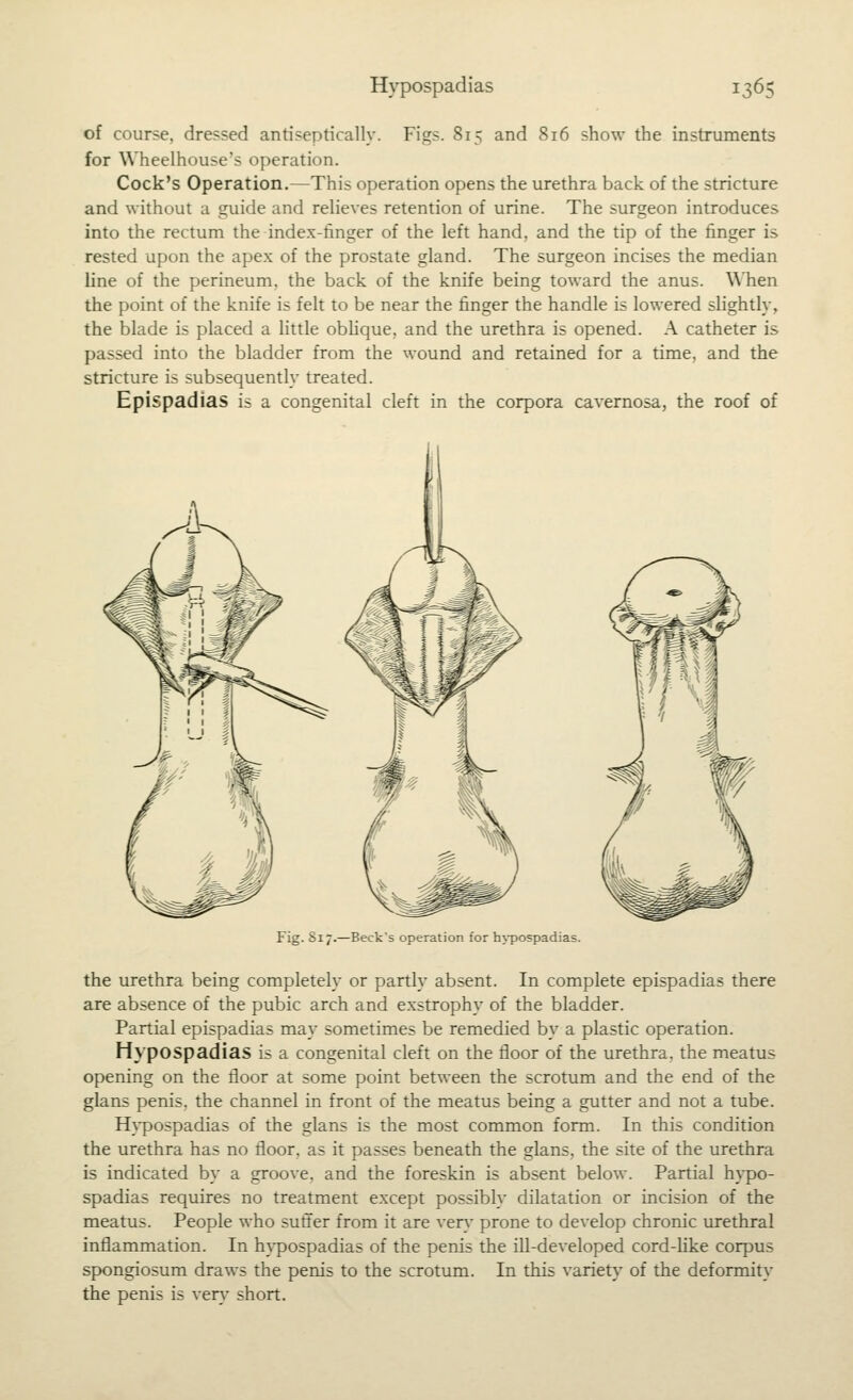 of course, dressed antiseptically. Figs. 815 and 816 show the instruments for Wheelhouse's operation. Cock's Operation.—This operation opens the urethra back of the stricture and without a guide and relieves retention of urine. The surgeon introduces into the rectum the index-finger of the left hand, and the tip of the finger is rested upon the apex of the prostate gland. The surgeon incises the median line of the perineum, the back of the knife being toward the anus. When the point of the knife is felt to be near the finger the handle is lowered slightly, the blade is placed a little obhque, and the urethra is opened. A catheter is passed into the bladder from the wound and retained for a time, and the stricture is subsequently treated. Epispadias is a congenital cleft in the corpora cavernosa, the roof of Fig. 817.—Beck's operation for h>-pospadias. the urethra being completely or partly absent. In complete epispadias there are absence of the pubic arch and exstrophy of the bladder. Partial epispadias may sometimes be remedied by a plastic operation. Hypospadias is a congenital cleft on the floor of the urethra, the meatus opening on the floor at some point between the scrotum and the end of the glans penis, the channel in front of the meatus being a gutter and not a tube. H}-po5padias of the glans is the most common form. In this condition the urethra has no floor, as it passes beneath the glans, the site of the urethra is indicated by a groove, and the foreskin is absent below. Partial h}-po- spadias requires no treatment except possibly dilatation or incision of the meatus. People who sufi^er from it are ver}- prone to develop chronic urethral inflammation. In hypospadias of the penis the iU-developed cord-like corpus spongiosum draws the penis to the scrotum. In this variety of the deformity the penis is ver}' short.