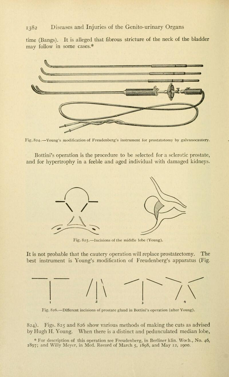 time (Bangs). It is alleged that fibrous stricture of the neck of the bladder may follow in some cases.* Fig..824.—Young's modification of Freudenberg's instrument for prostatotomy by galvanocautery. Bottini's operation is the procedure to be selected for a sclerotic prostate, and for hypertrophy in a feeble and aged individual with damaged kidneys. Fig. 825.—Incisions of the middle lobe (Young). It is not probable that the cautery operation will replace prostatectomy. The best instrument is Young's modification of Freudenberg's apparatus (Fig. \ Fig. 826.—Different incisions of prostate gland in Bottini's operation (after Young). 824). Figs. 825 and 826 show various methods of making the cuts as advised by Hugh H. Young. When there is a distinct and pedunculated median lobe, * For description of this operation see Freudenberg, in Berliner klin. Worh., No. 46, 1897; and Willy Meyer, in Med. Record of March 5, 1898, and May 12, 1900.