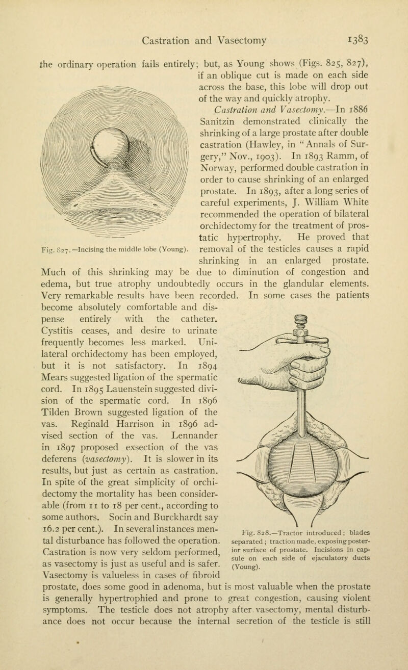 Castration and Vasectomy ^3^3 Fi'e;. S27.—Incising the middle lobe (Young). the ordinary operation fails entirely; but, as Young shows (Figs. 825, 827), if an oblique cut is made on each side across the base, this lobe will drop out of the way and quickly atrophy. Castration and Vasectomy.—In 1886 Sanitzin demonstrated clinically the shrinking of a large prostate after double castration (Hawley, in  Annals of Sur- gery, Nov., 1903). In 1893 Ramm, of Norway, performed double castration in order to cause shrinking of an enlarged prostate. In 1893, after a long series of careful experiments, J. William White recommended the operation of bilateral orchidectomy for the treatment of pros- tatic hypertrophy. He proved that removal of the testicles causes a rapid shrinking in an enlarged prostate. Much of this shrinking may be due to diminution of congestion and edema, but true atrophy undoubtedly occurs in the glandular elements. Very remarkable results have been recorded. In some cases the patients become absolutely comfortable and dis- pense entirely with the catheter. Cystitis ceases, and desire to urinate frequently becomes less marked. Uni- lateral orchidectomy has been employed, but it is not satisfactory. In 1894 Mears suggested ligation of the spermatic cord. In 1895 Lauenstein suggested divi- sion of the spermatic cord. In 1896 Tilden Brown suggested ligation of the vas. Reginald Harrison in 1896 ad- vised section of the vas. Lennander in 1897 proposed exsection of the vas deferens (vasectomy). It is slower in its results, but just as certain as castration. In spite of the great simplicity of orchi- dectomy the mortality has been consider- able (from II to 18 per cent., according to some authors. Socin and Burckhardt say 16.2 per cent.). In several instances men- tal disturbance has followed the operation. Castration is now very seldom performed, as vasectomy is just as useful and is safer. Vasectomy is valueless in cases of fibroid prostate, does some good in adenoma, but is most valuable when the prostate is generally hypertrophied and prone to great congestion, causing violent s)'Tnptoms. The testicle does not atrophy after vasectomy, mental disturb- ance does not occur because the internal secretion of the testicle is still Fig. 828.—Tractor introduced ; blades separated ; traction made, exposing poster- ior surface of prostate. Incisions in cap- sule on each side of ejaculatory ducts